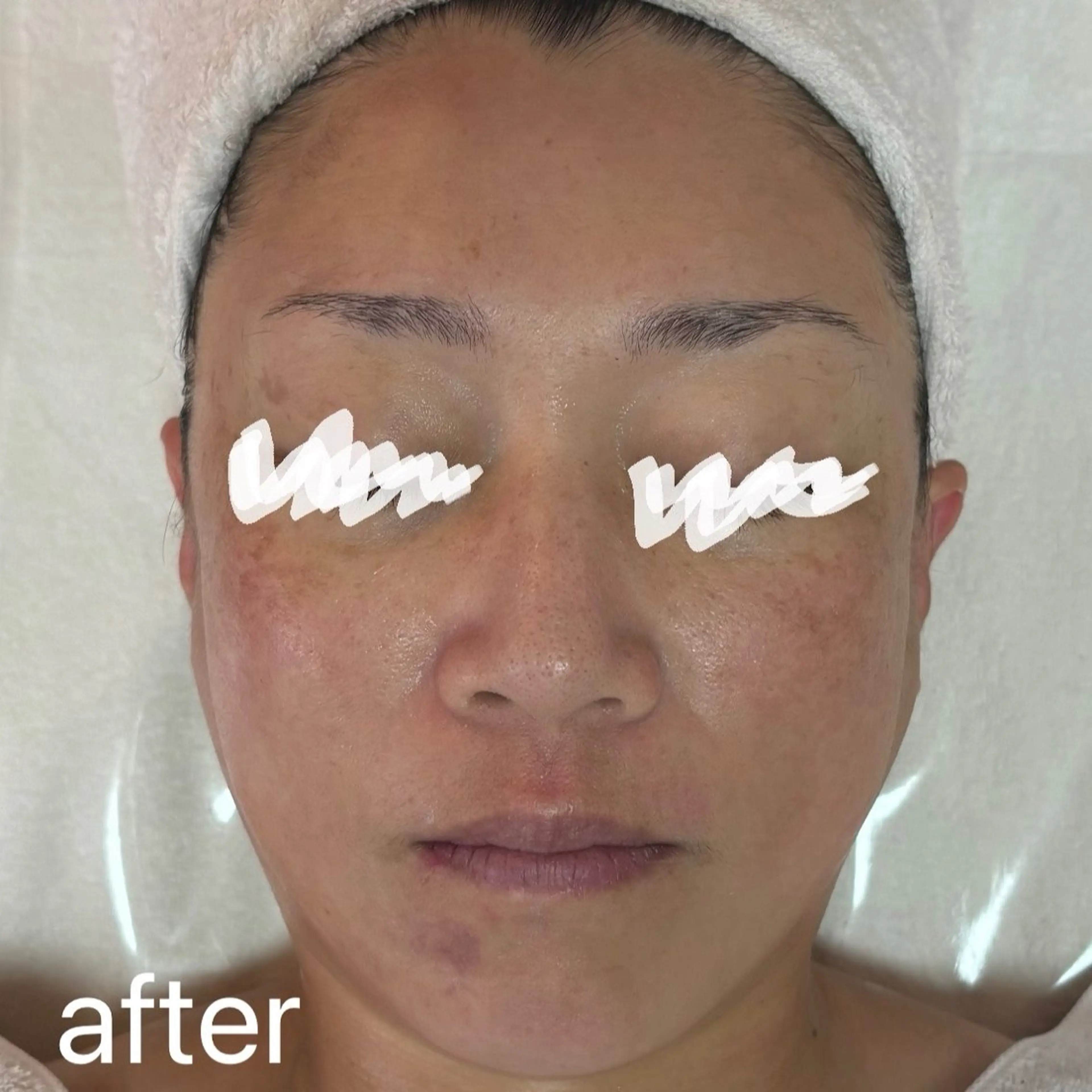 エステ 肌質改善|天王寺 For...はるかのエステ・リラクイメージ