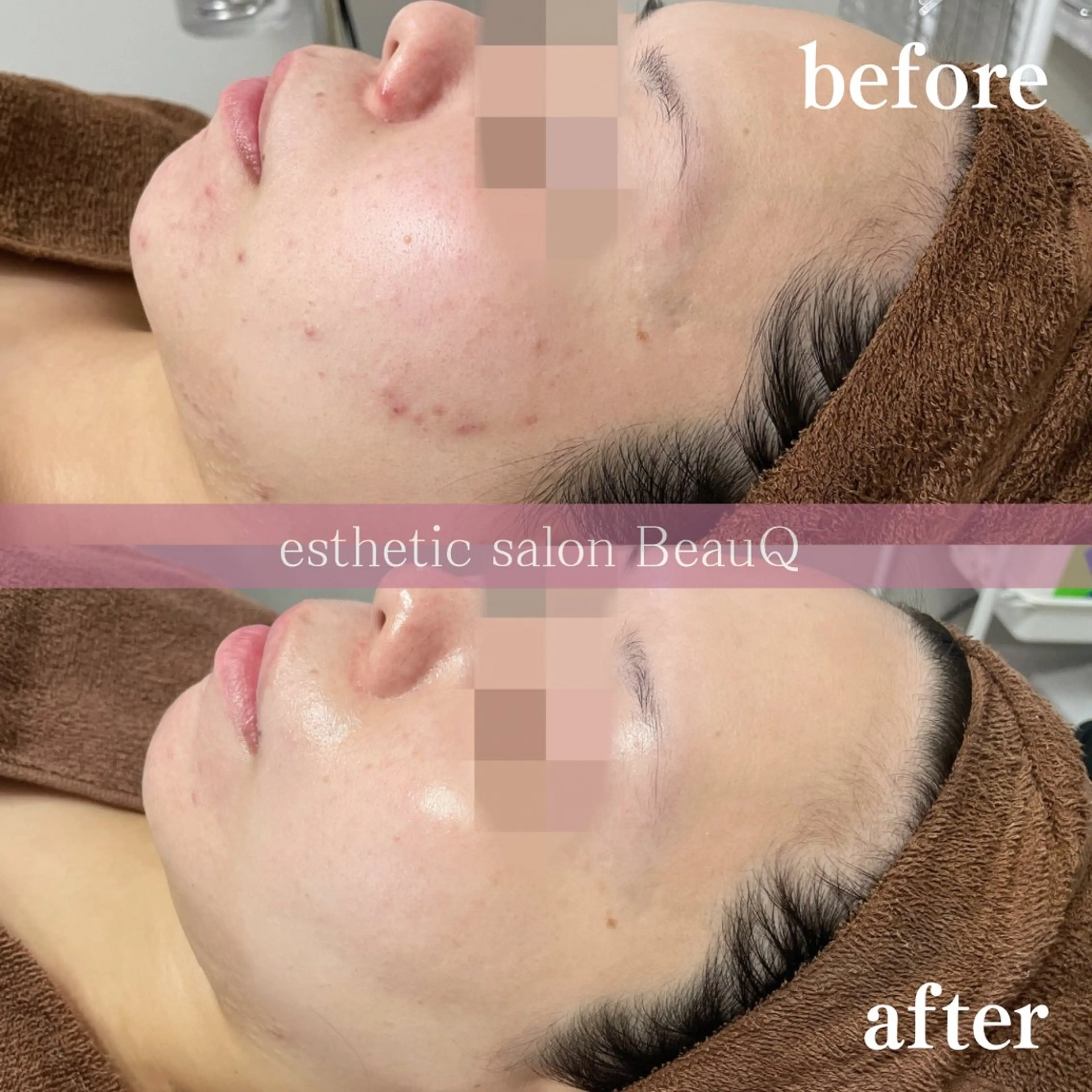 肌質改善/ブライダル 水上百華のエステ・リラクイメージ