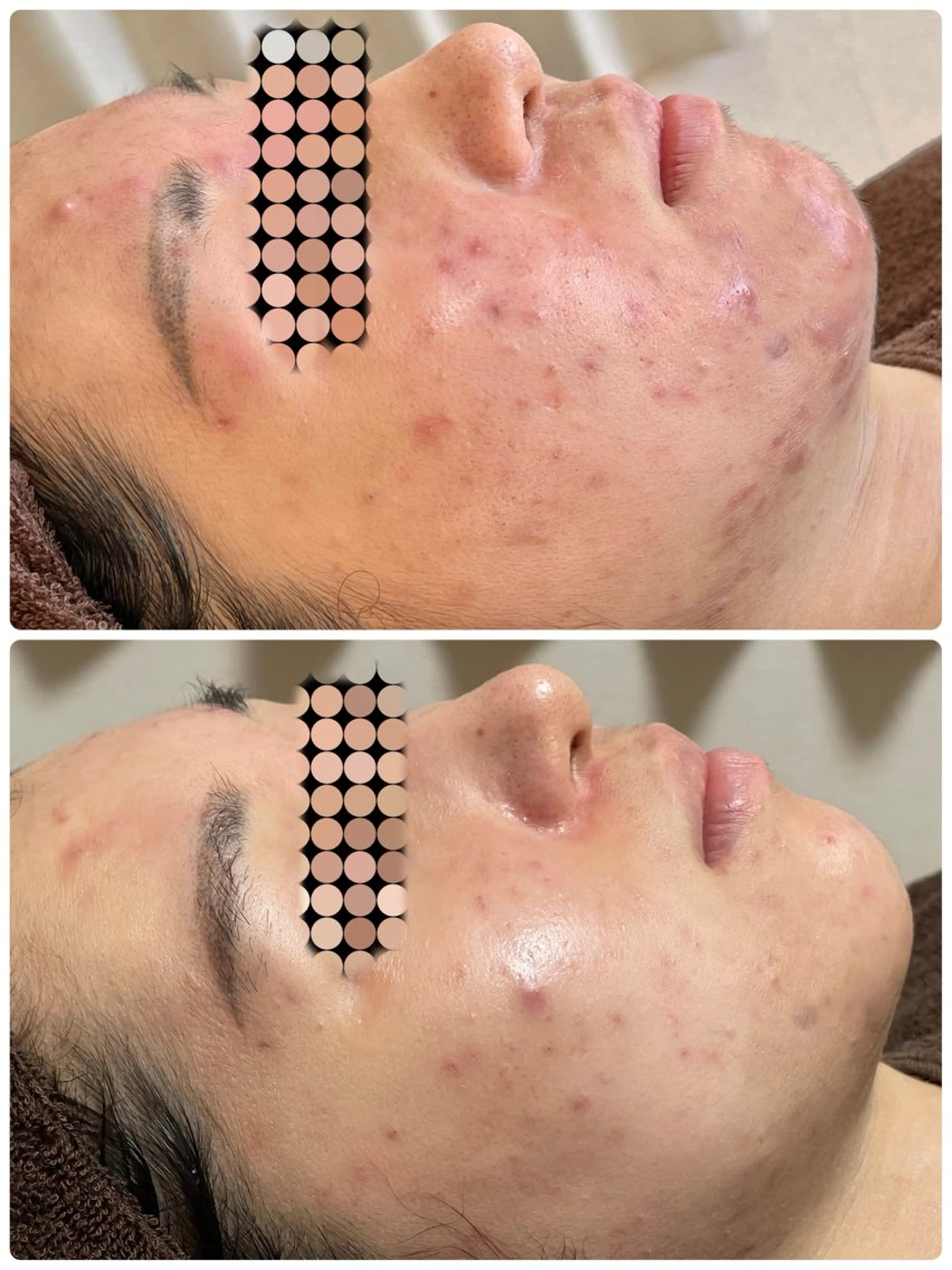 バイオニックセルサーコース【ニキビ】の写真