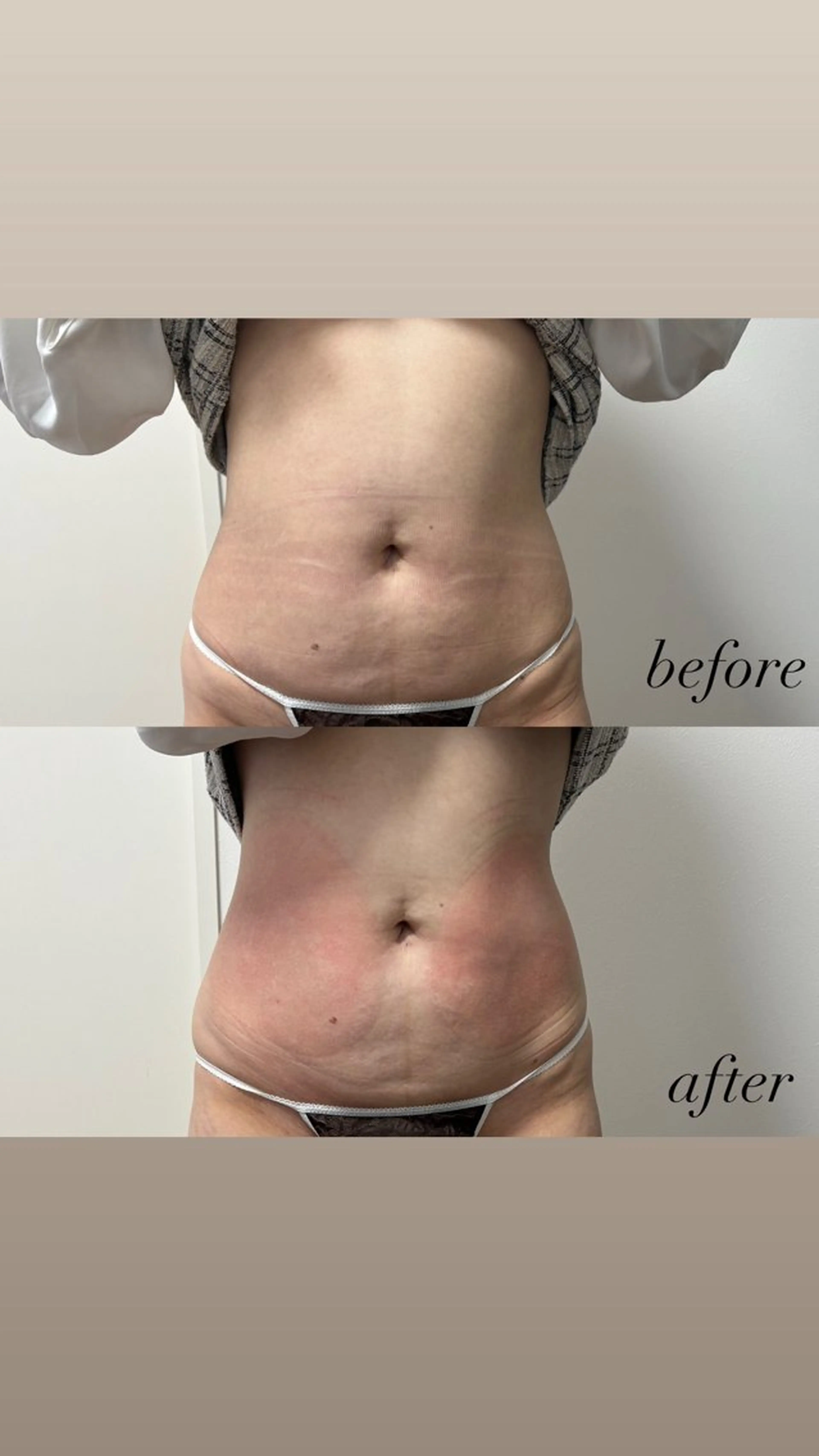 エステ Miiju.所属・Miiju. 石巻市 脂肪冷却  鈴木のエステ・リラクイメージ