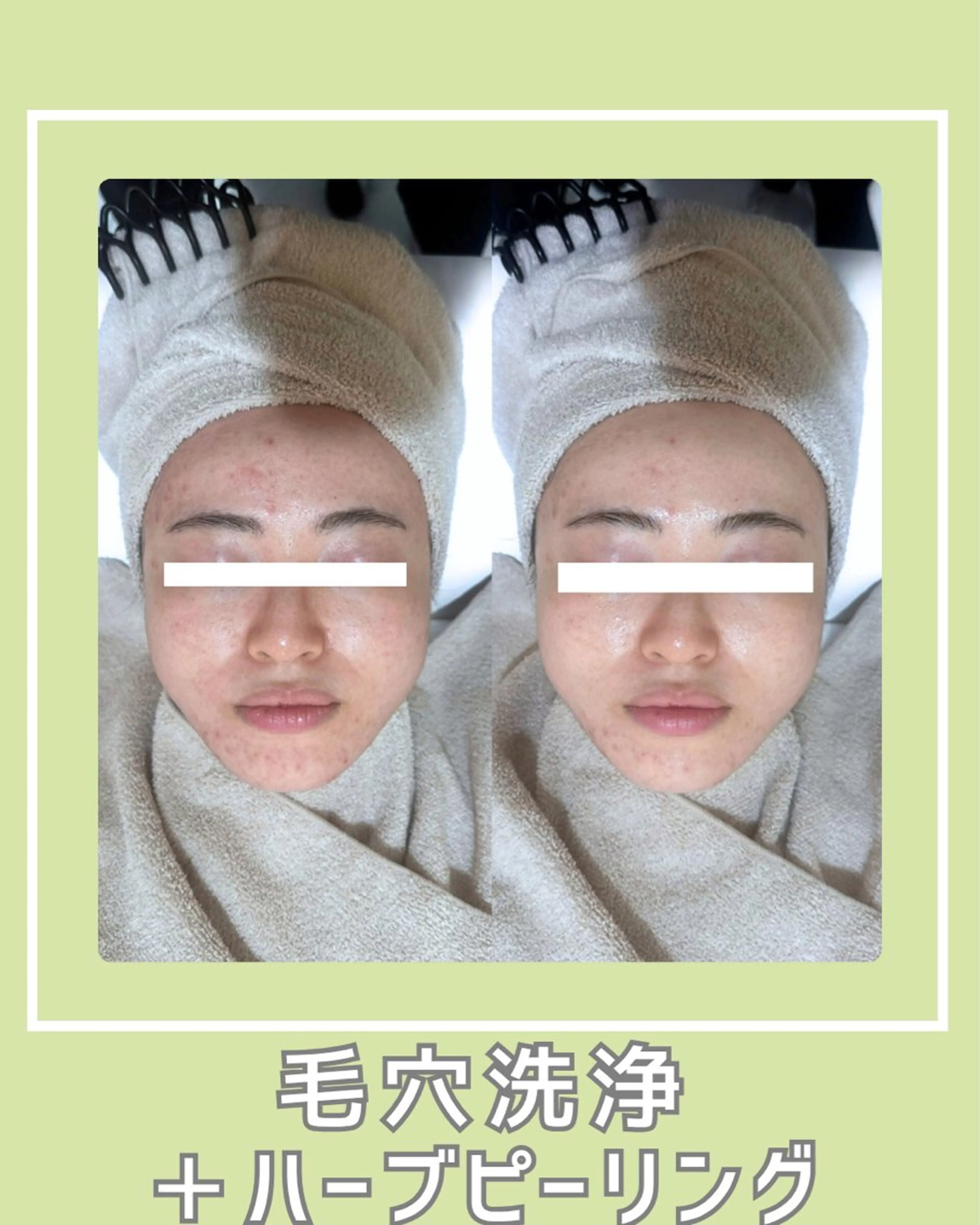 エステ |ピーリング・毛穴| soina神楽坂のエステ・リラクイメージ