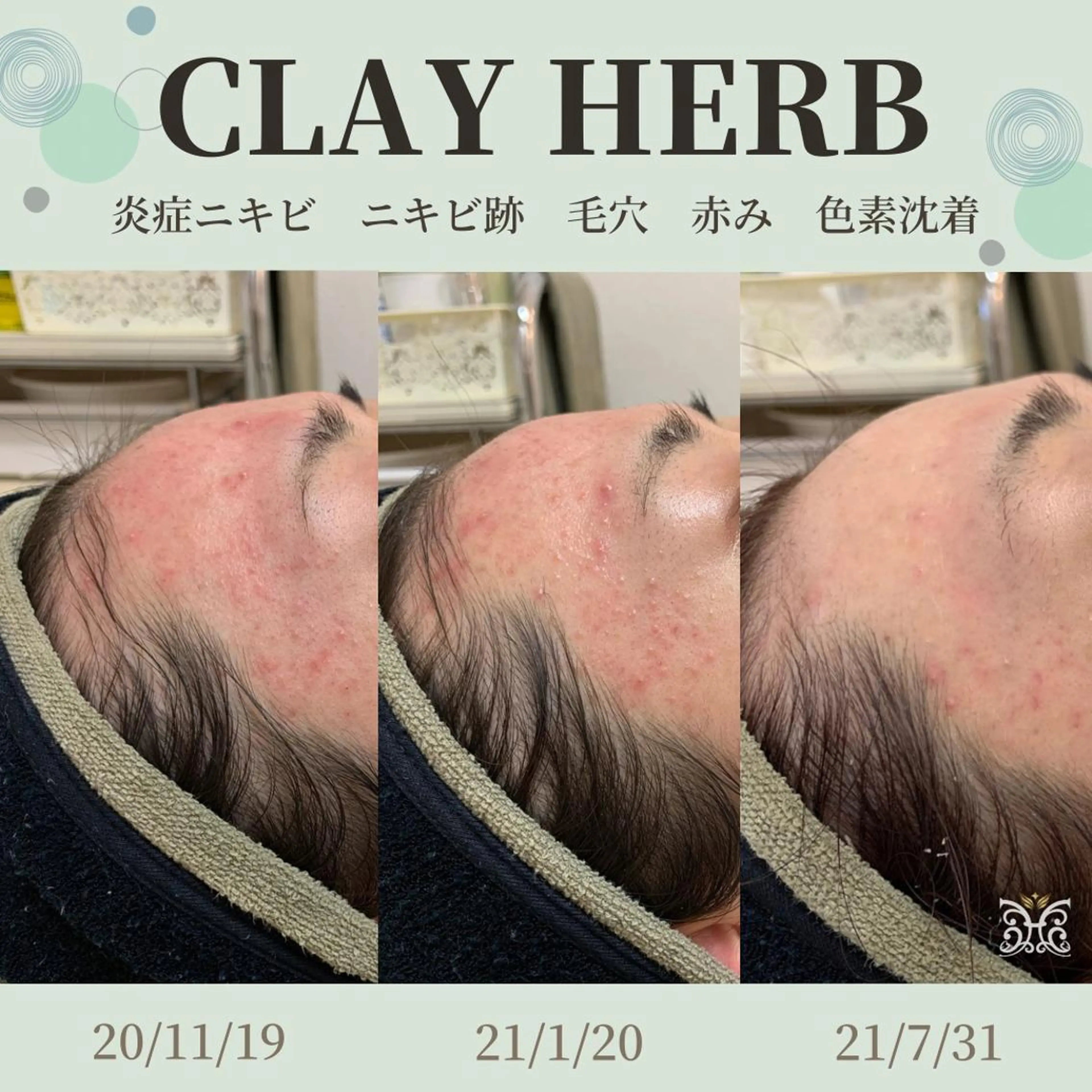 エステ リラク 【剥離ありハーブピーリング専門エステ】cerisier BEAUTÉ 原宿所属・cerisier BEAUTÉのエステ・リラクイメージ