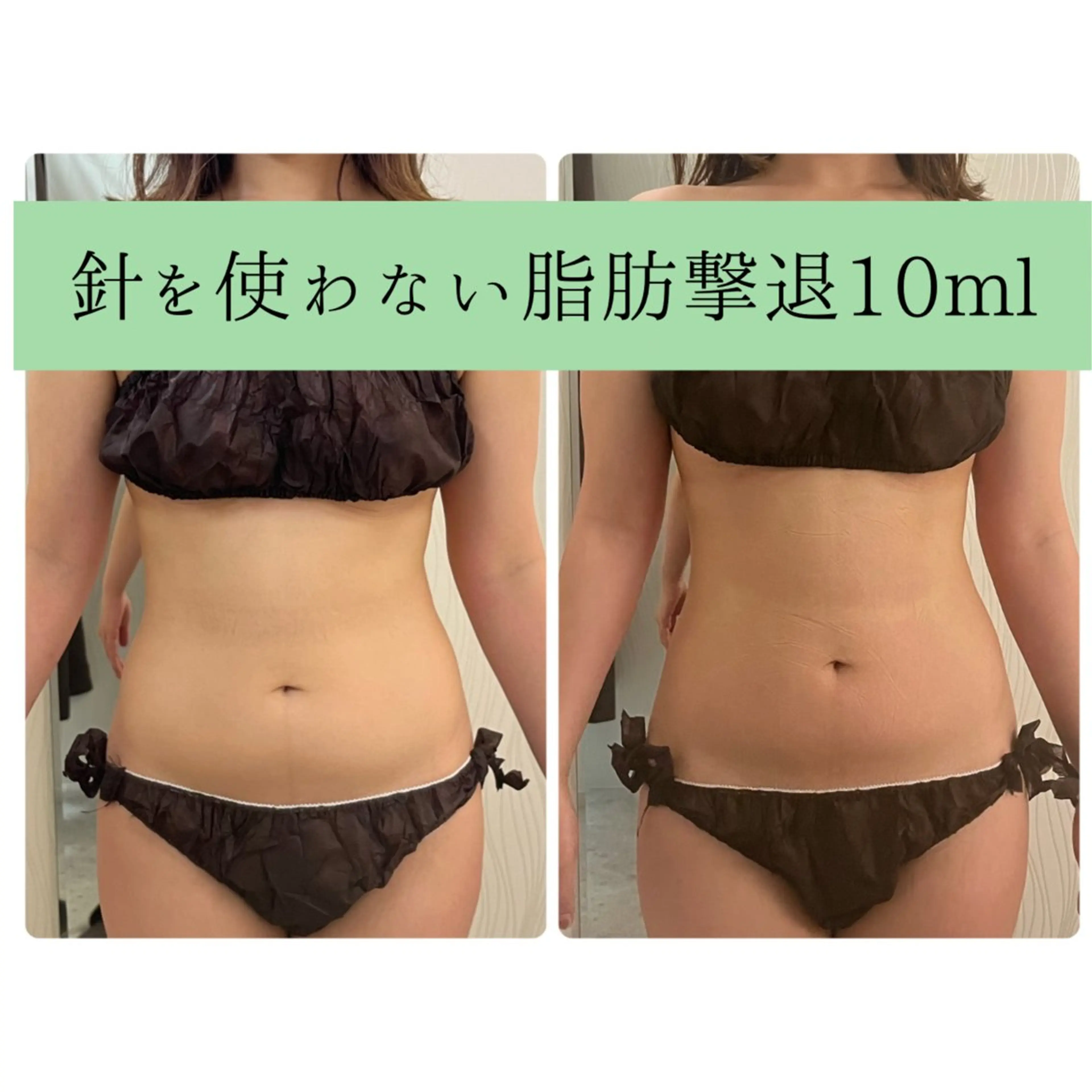 🌹モニター🌹残5名様💠針を使わない脂肪撃退💠後戻り0🙆‍♀️お身体1部位(10ml)¥39600⇨の写真