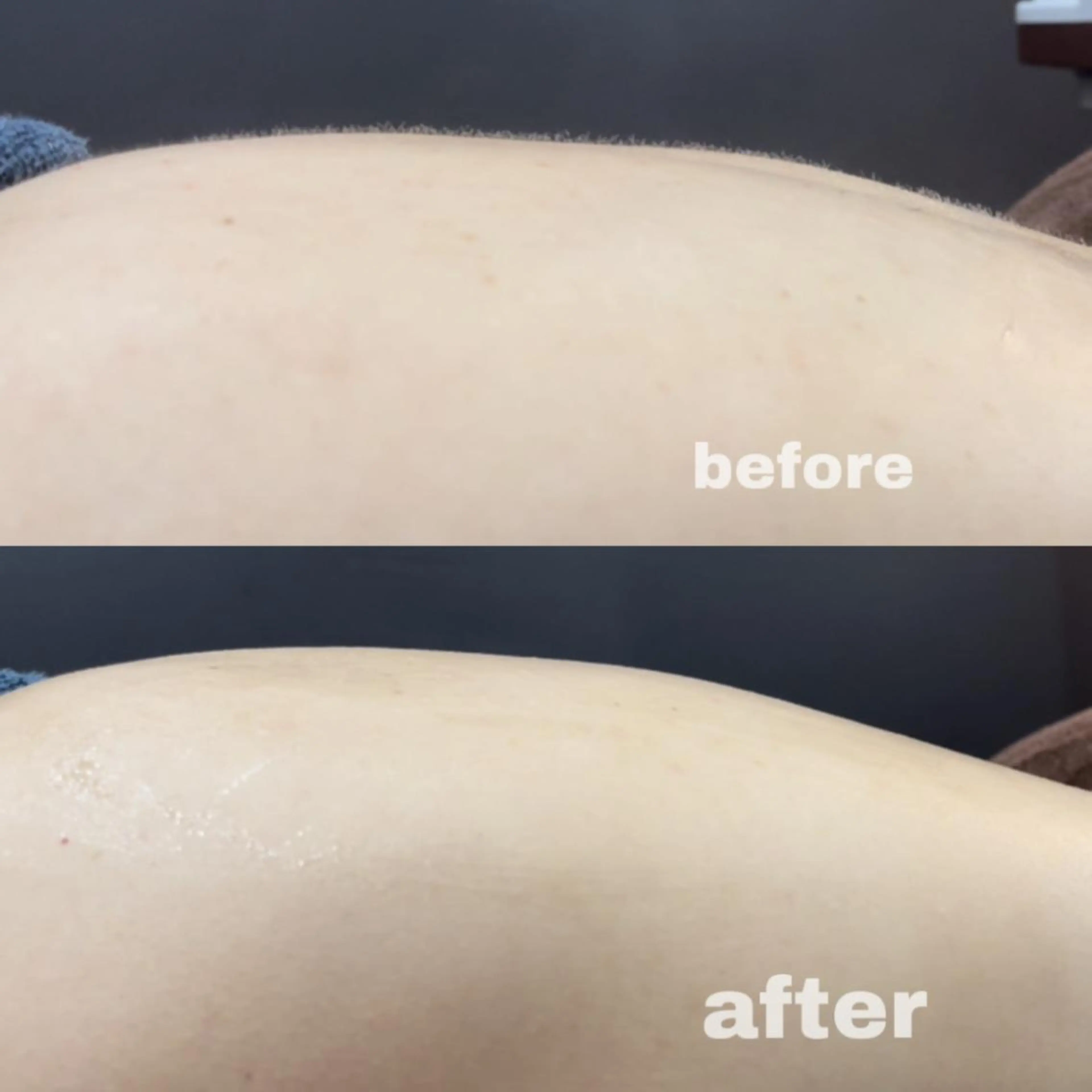 脱毛前に大人気◎背中全体シェービング🪒の写真