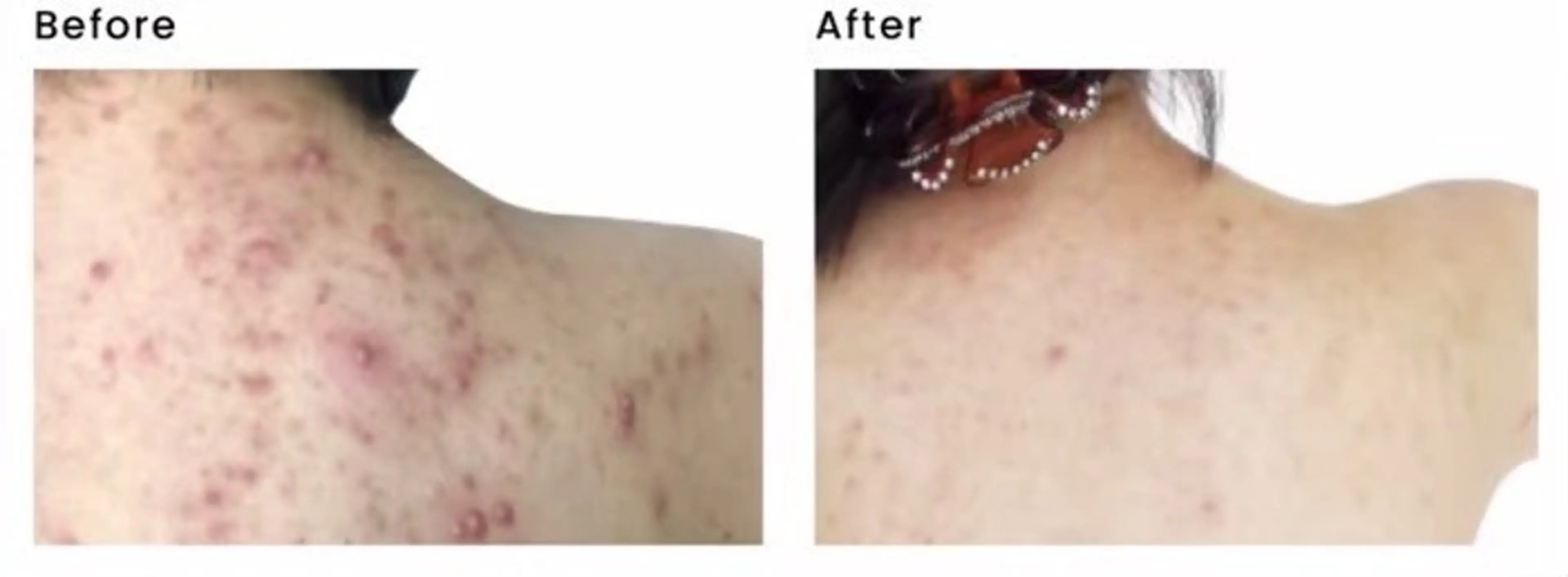 マイクロニードル美容の写真