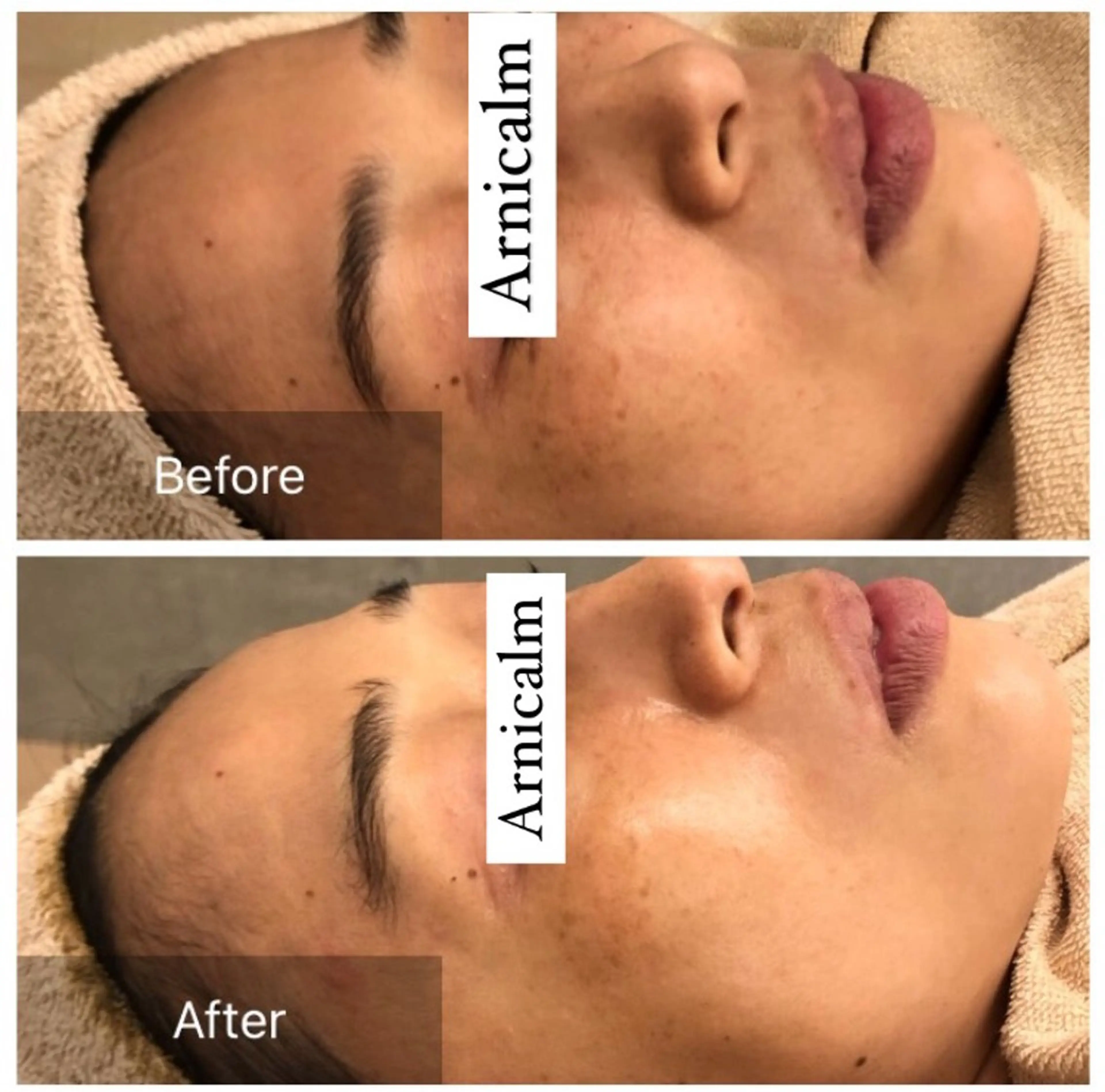 エステ ハーブピーリング 肌再生ピーリング/のエステ・リラクイメージ