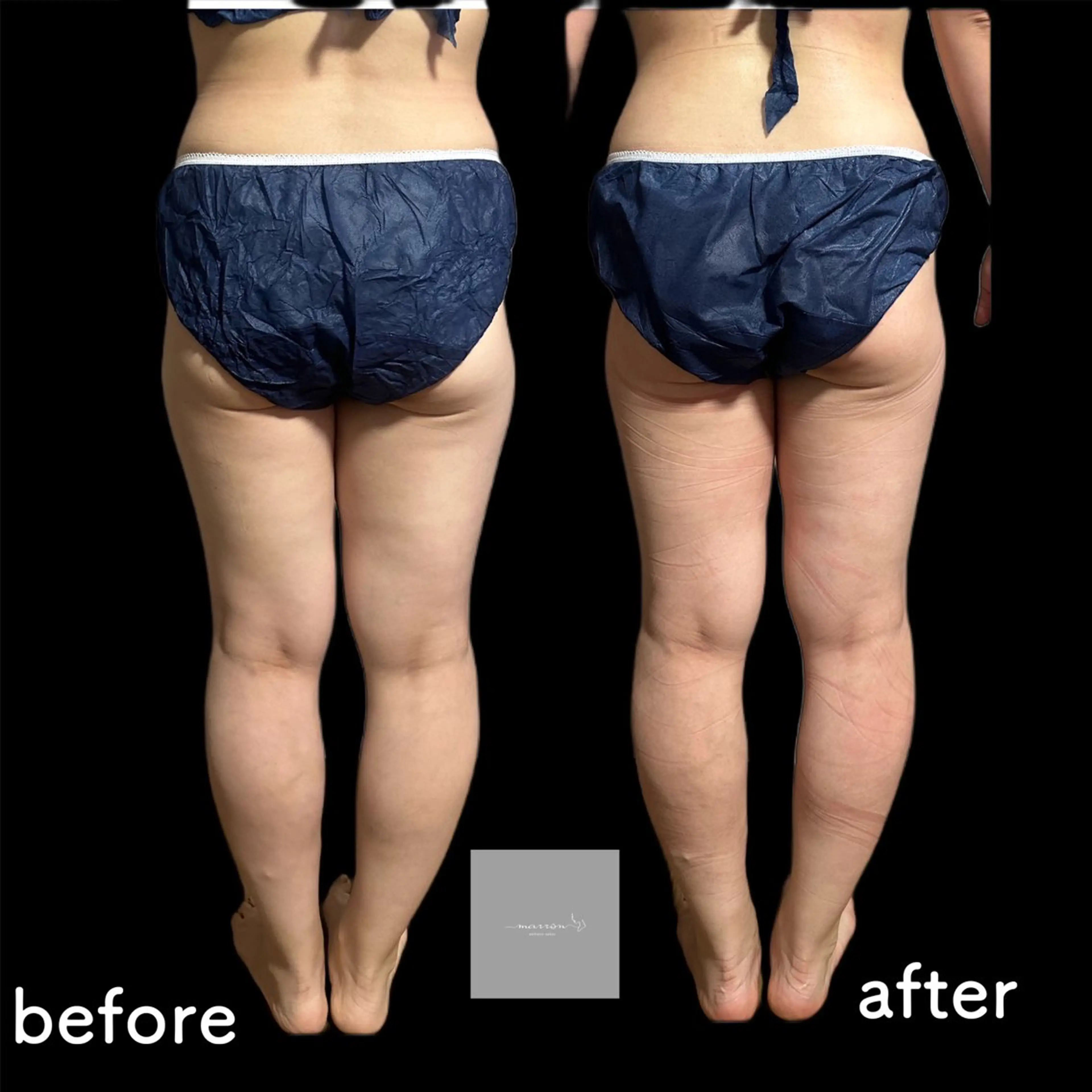 marron所属・痩身ハイパーナイフ ララピールリアボーテのエステ・リラクイメージ