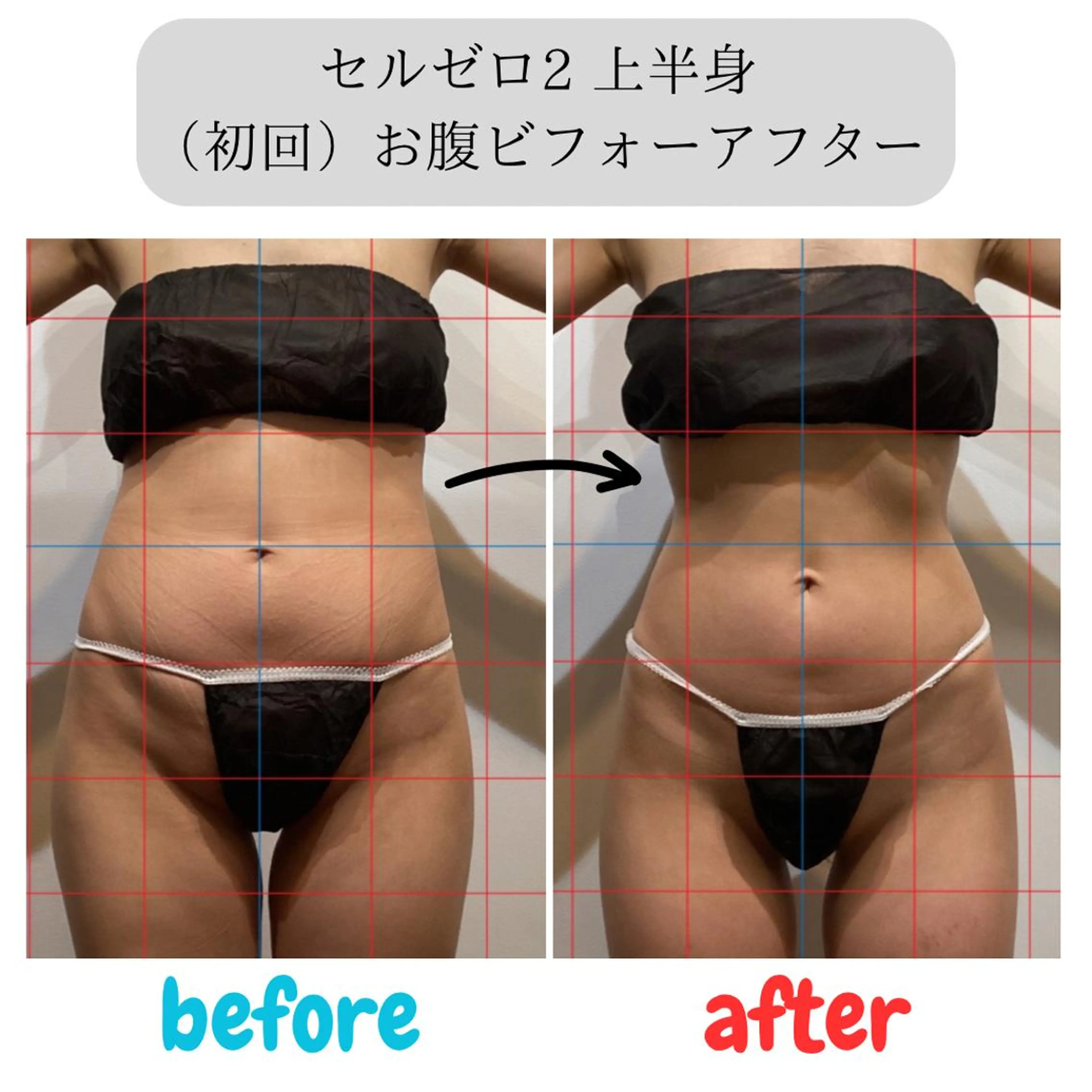 【ずっと同価格】上半身90分♪キュッとくびれ/二の腕/肩こり◎キャビテーション+ラジオ波+吸引🔥￥6000※生理中NGの写真