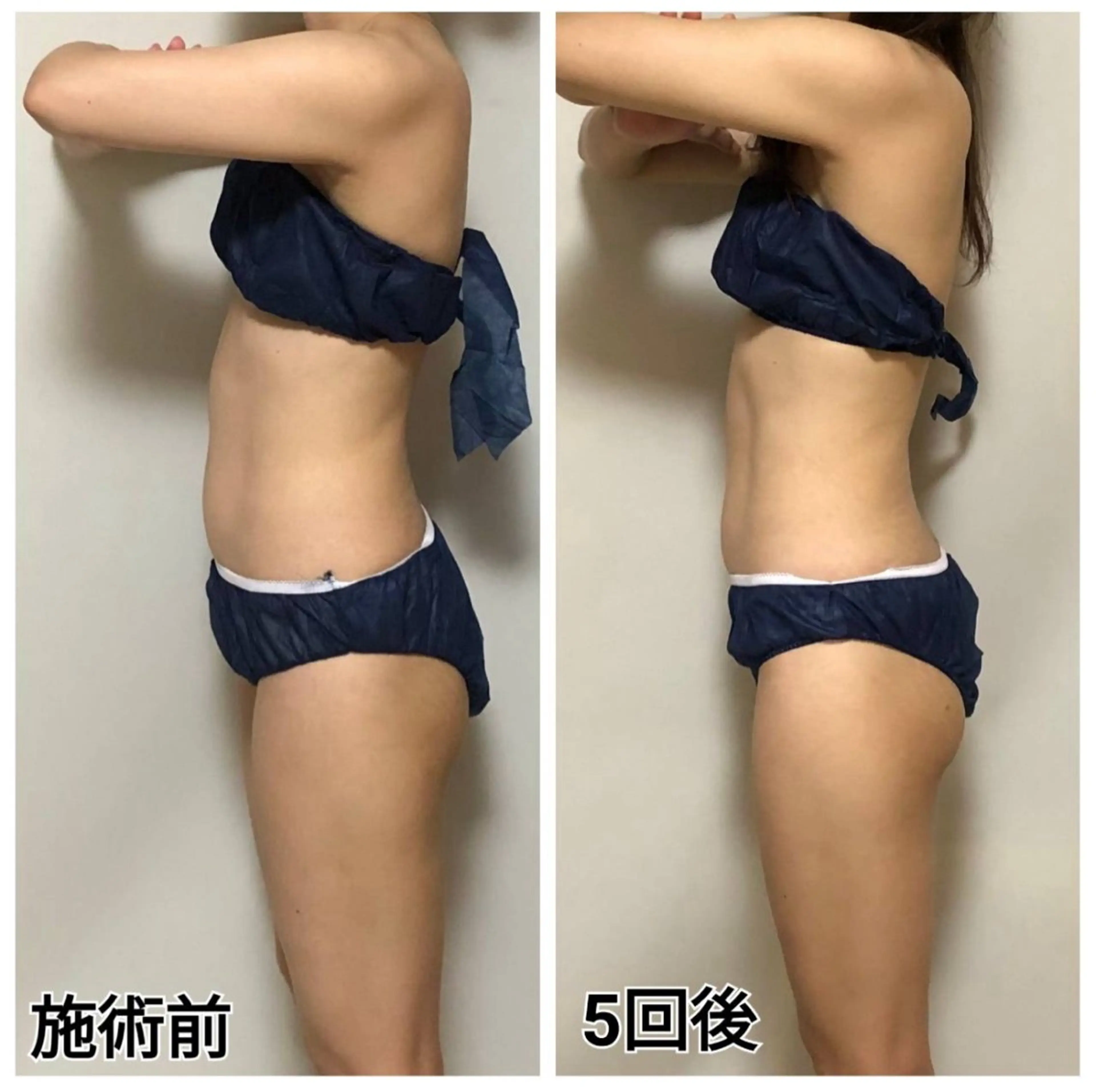 歯のホワイトニング＋寝るだけで脂肪撃退・筋肉増強セット💕の写真