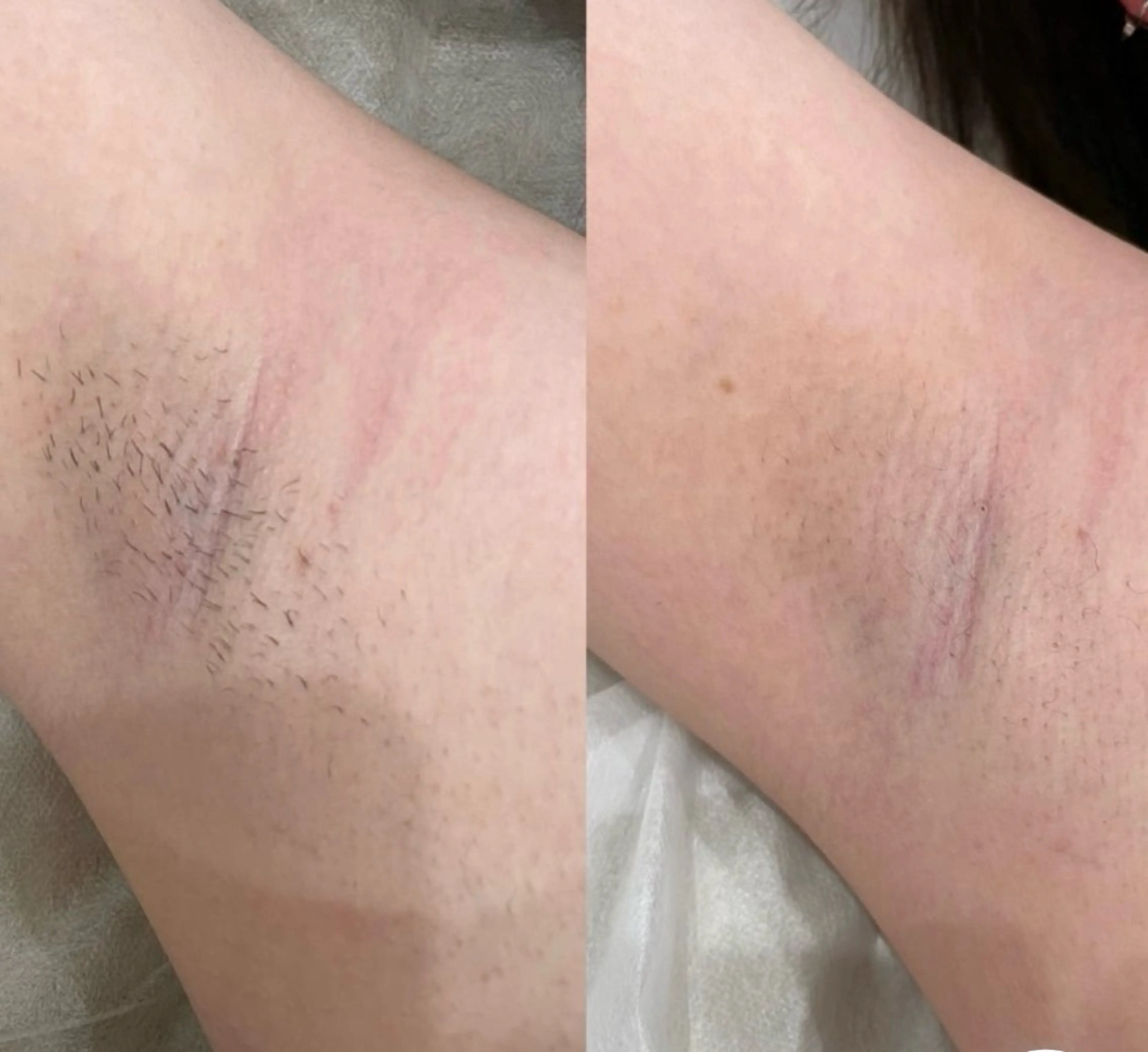 [夏に向けて☀️]脇脱毛⭐️の写真