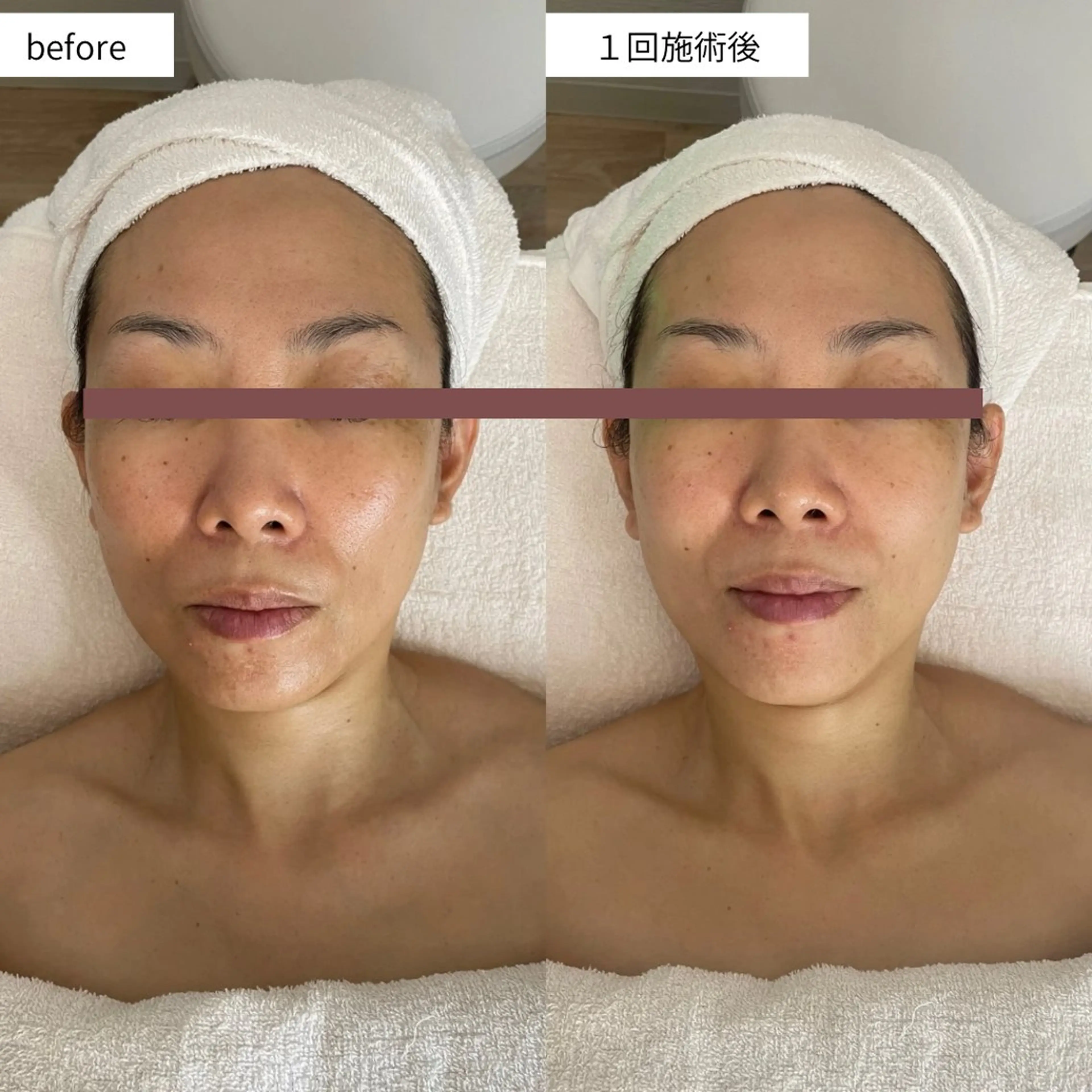 エステ シミ取り*韓国肌 エステサロン✶クロヌのエステ・リラクイメージ