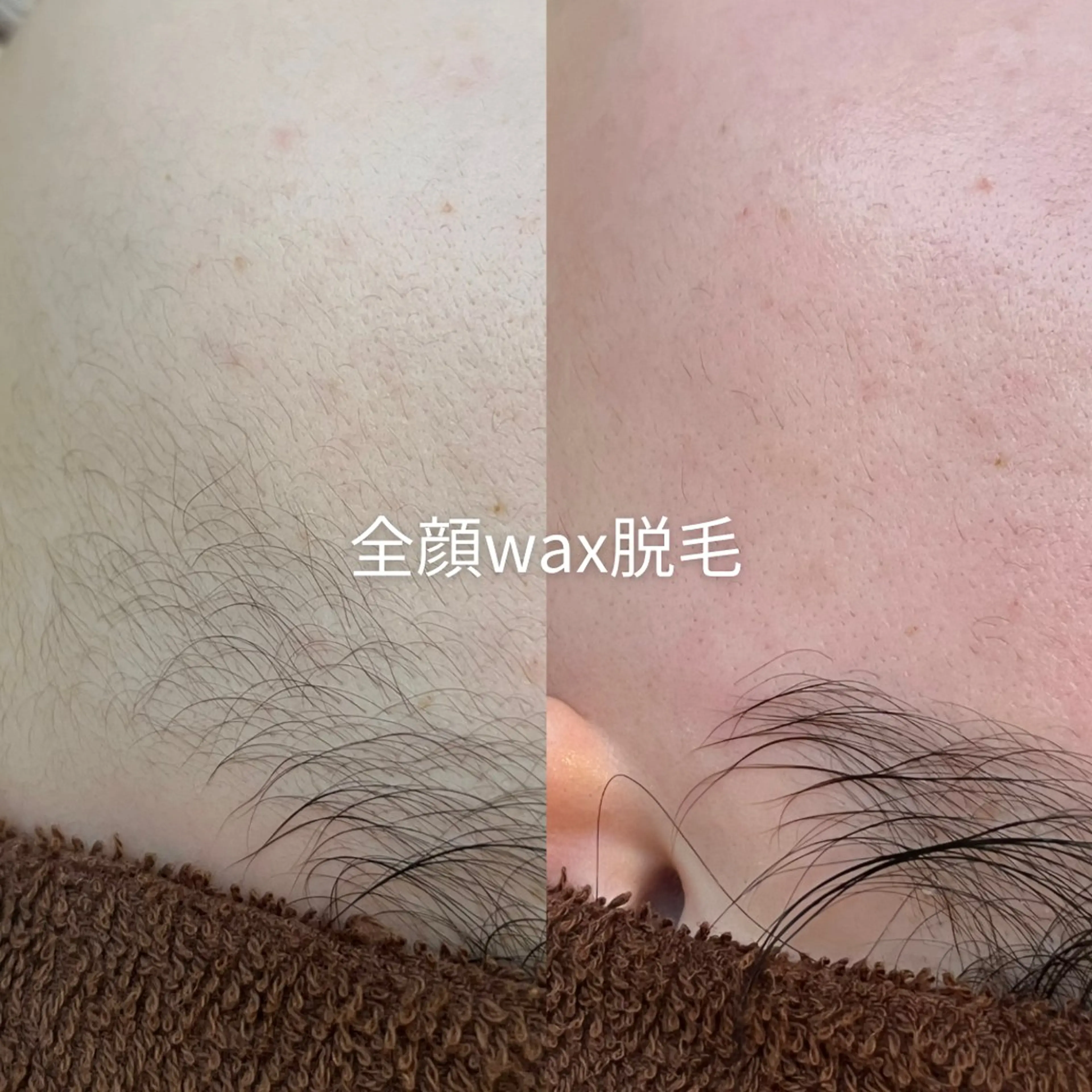 脱毛 EST BEAUTY所属・顔ワックス脱毛/ ハーブピーリングのエステ・リラクイメージ