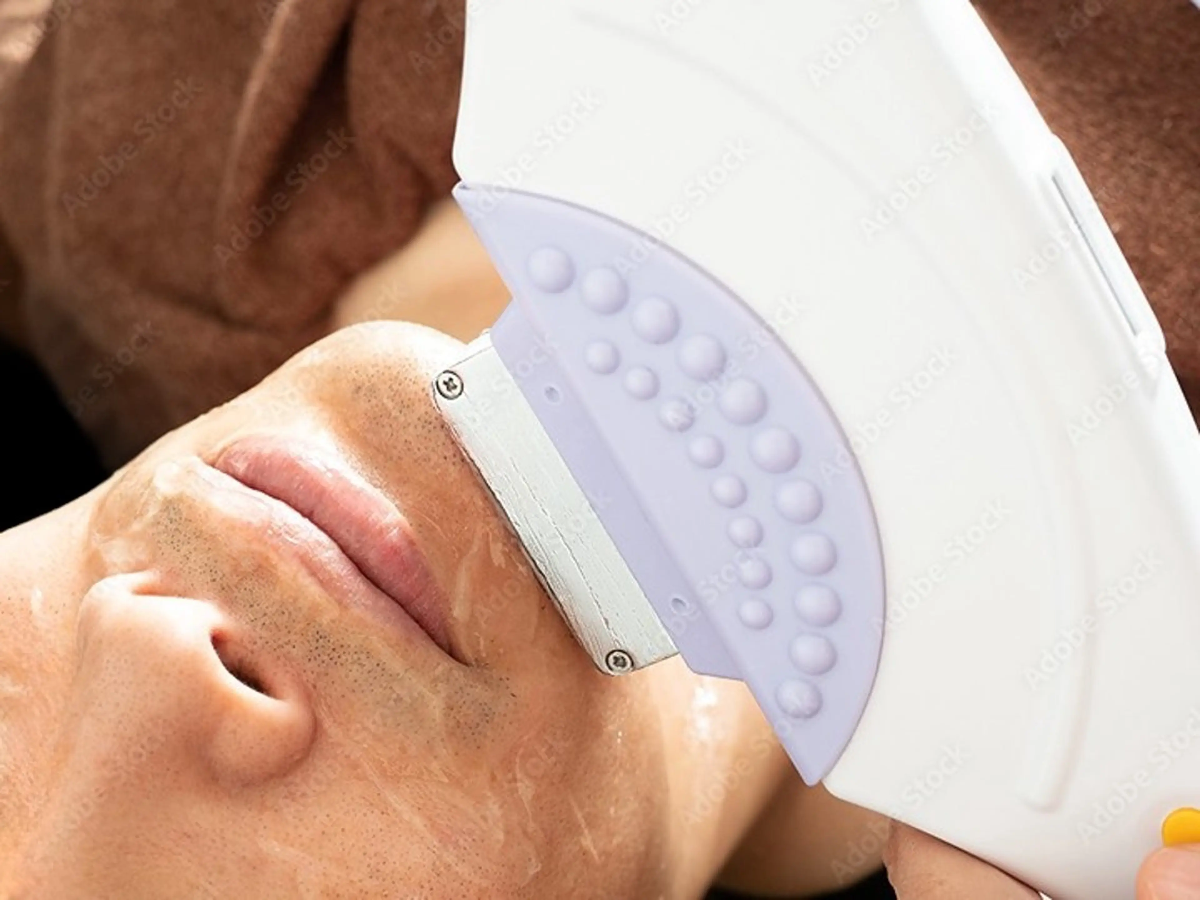 【毎朝のヒゲ剃り5分短縮!】青髭卒業へ!痛みを抑えた全顔ヒゲ脱毛¥10,000→¥5,000の写真