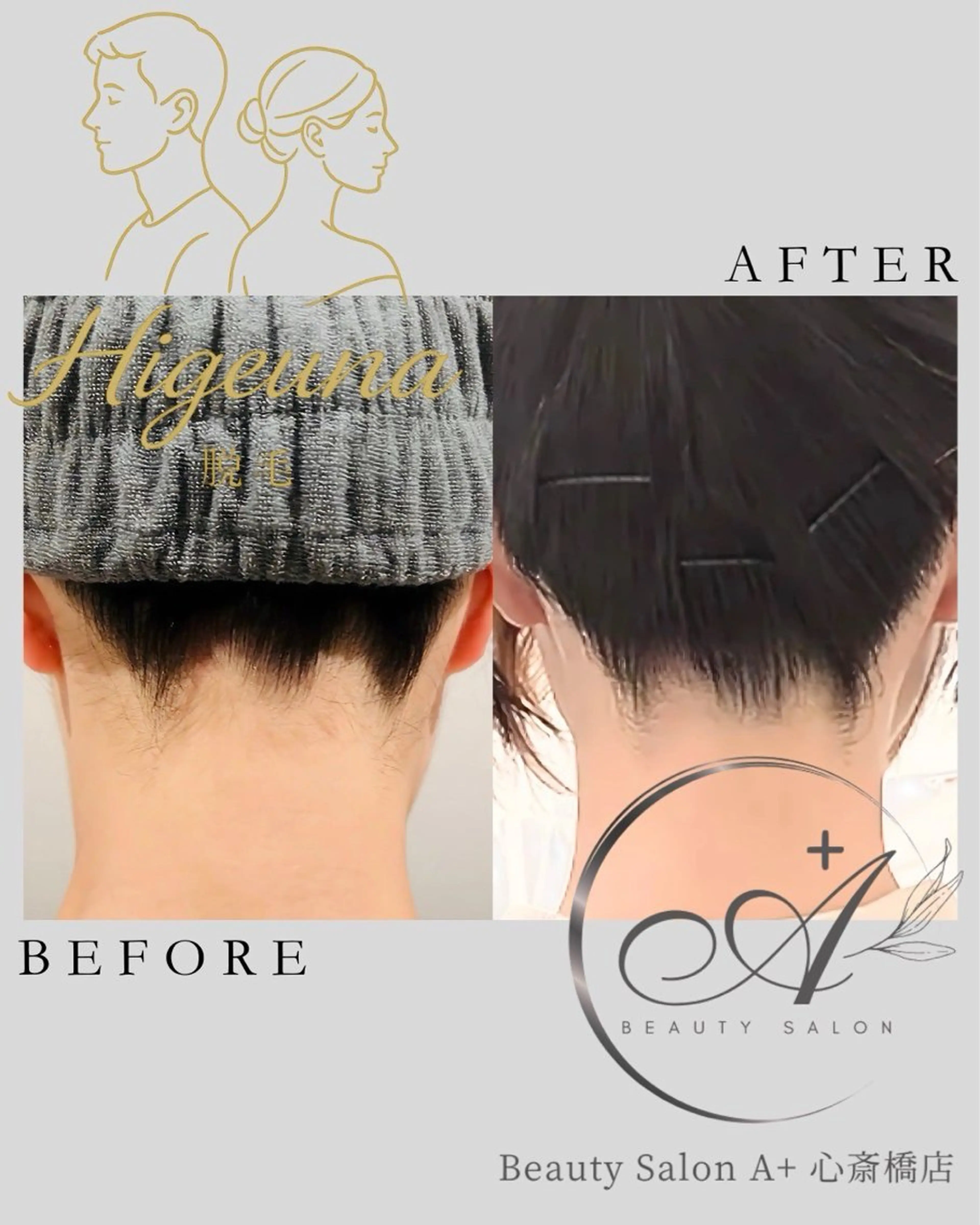 【ひげうな脱毛】口周り+うなじ！即冷却の痛み軽減脱毛🌈ムダ毛脱毛でストレスフリーに🌟（都度払いOK脱毛）の写真