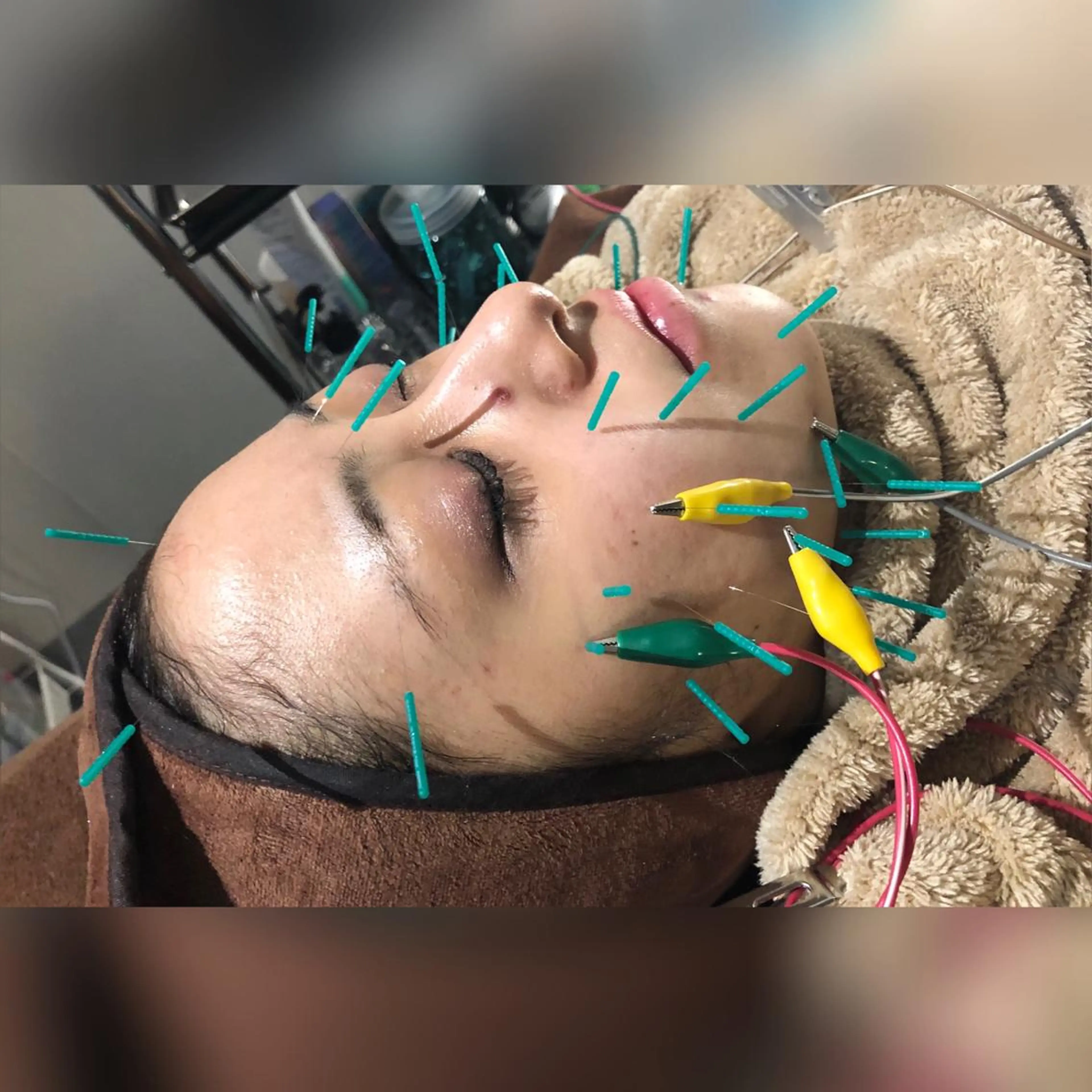 【画像提供】人気No.❷電気の美容鍼90分小顔、リフトアップ、ほうれい線、くすみ、ヒト幹細胞で超お得💖違いがわかる❣️の写真