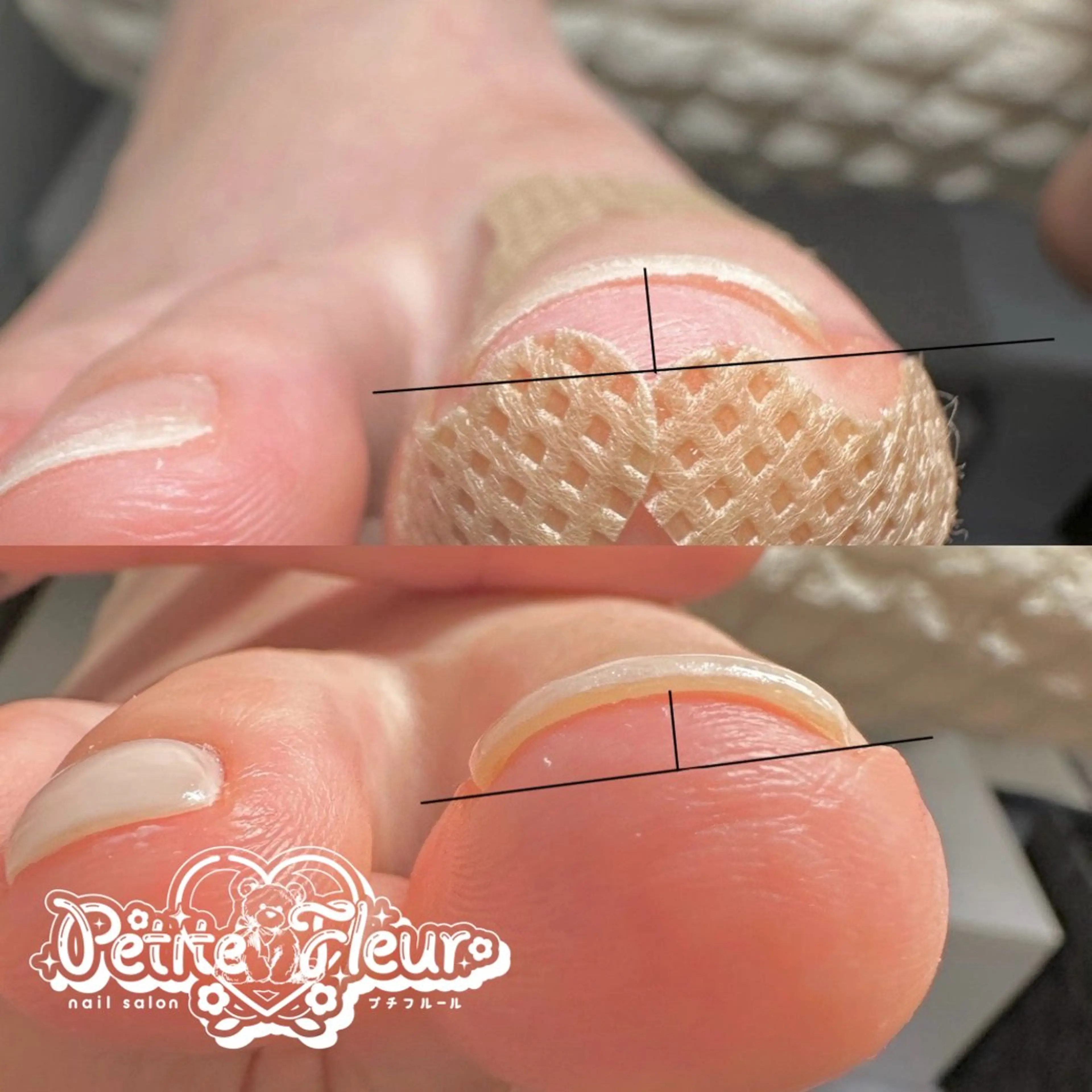 【フット】両親指のみ巻き爪ケアの写真