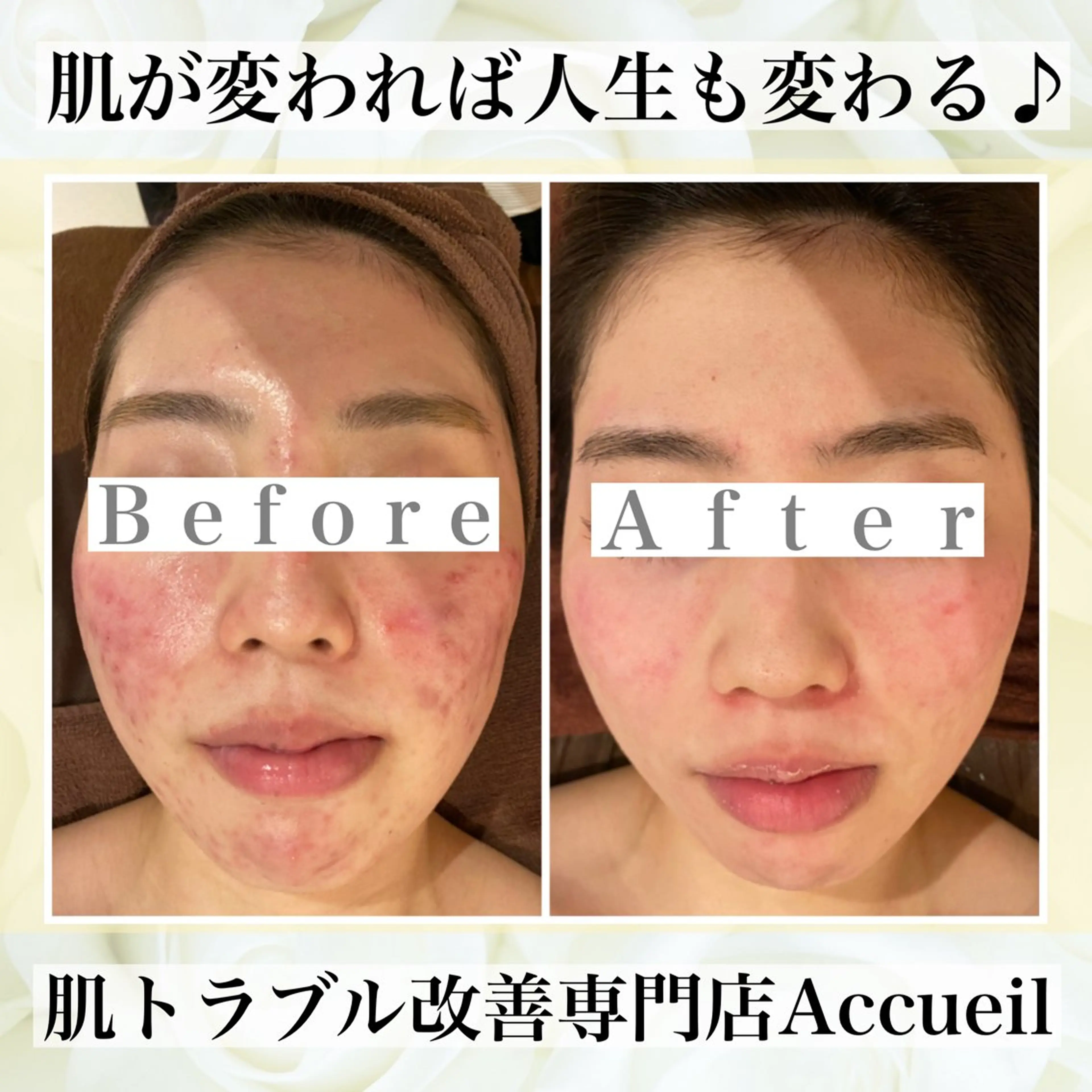 エステ リラク ニキビ・肌質改善専門 ♡人生が変わるサロンのエステ・リラクイメージ
