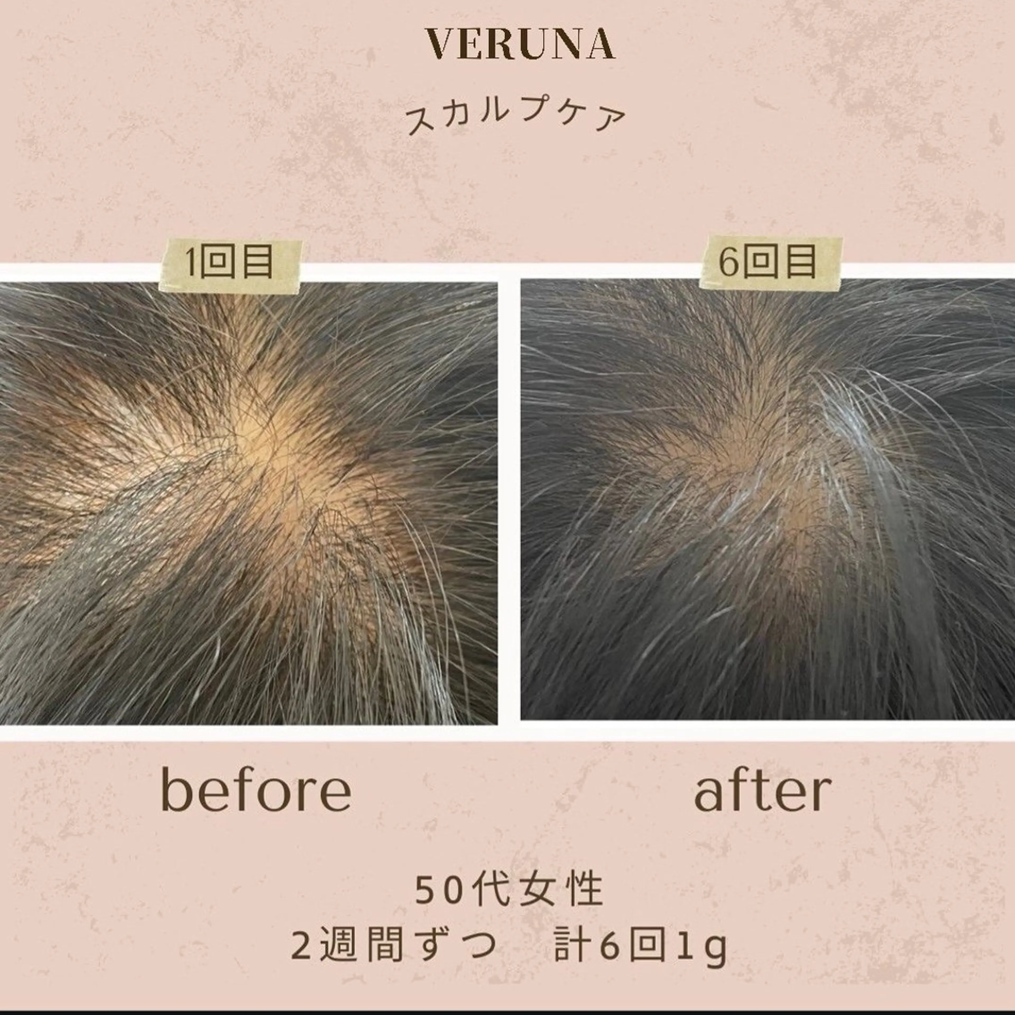 【薄毛】【円形脱毛】【分け目】スカルプトゲケア！毛根に栄養をたっぷり与えて、毛根生き生きと蘇らせる！再生ケア！3回コースの写真