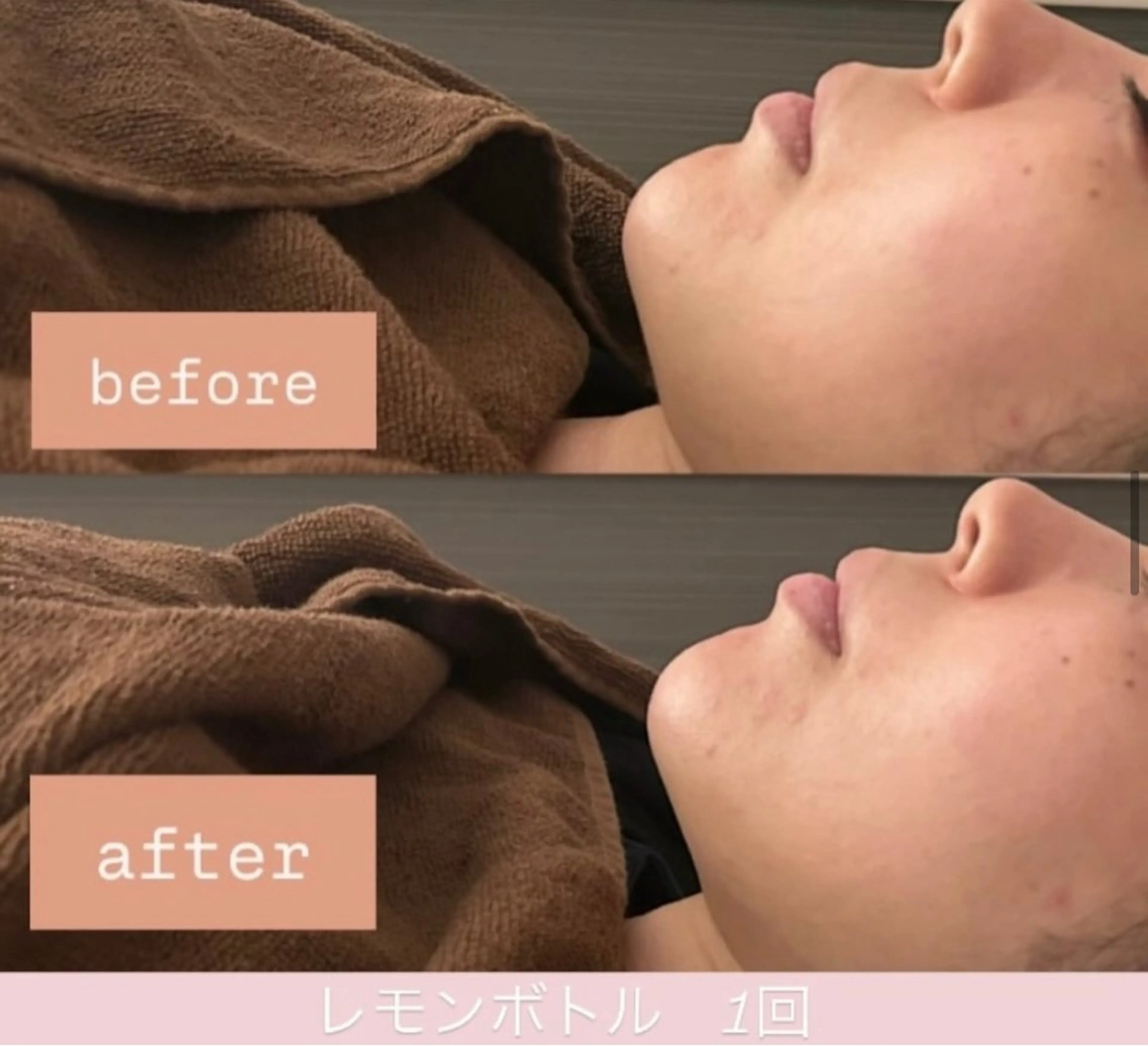 エステ 毛穴レス美肌へ🌿 看護師Abe🌼のエステ・リラクイメージ