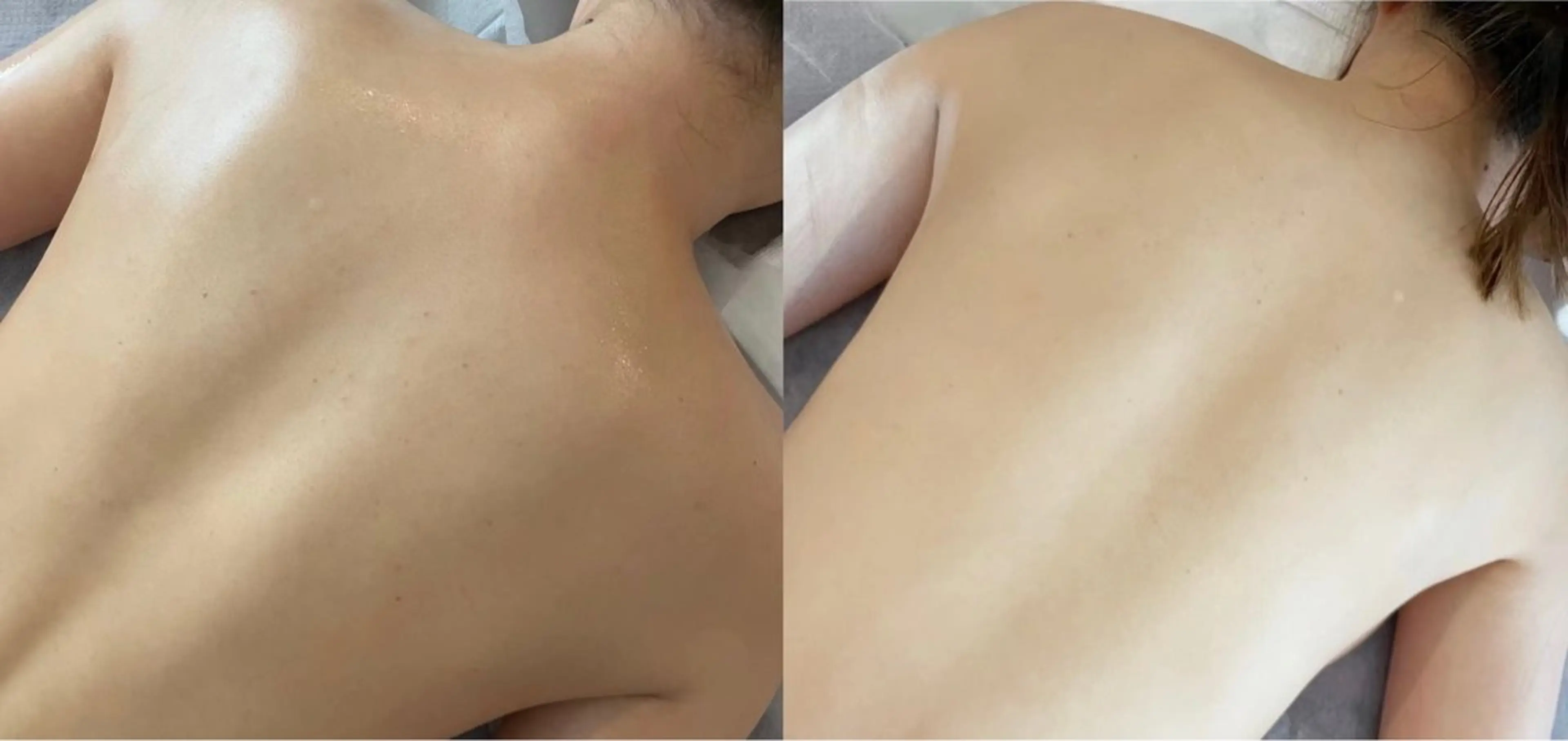 乳酸ピーリングボディー背中の写真