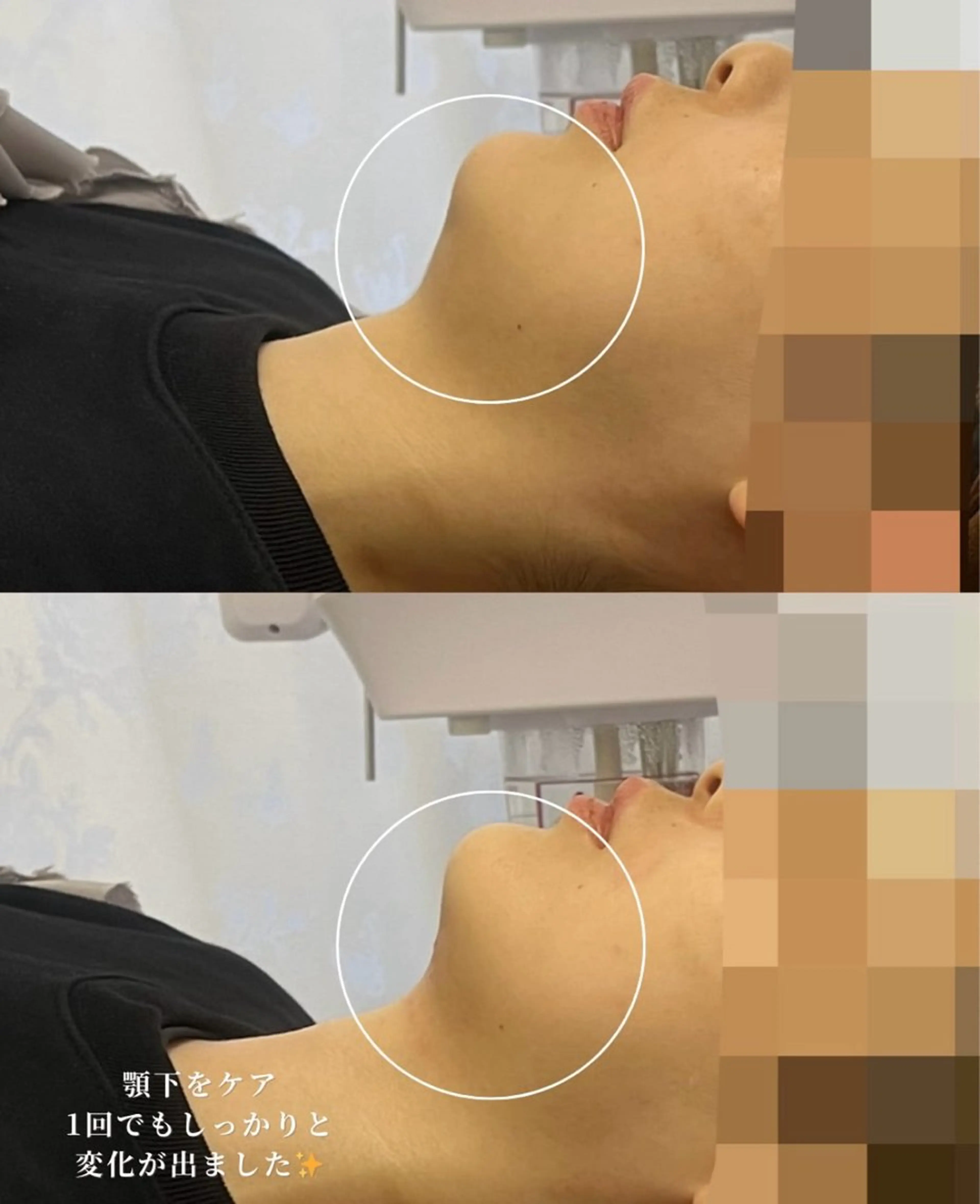 【4週間以内限定‼️】脂肪細胞アプローチ🍋小顔施術でリバウンドなし🙆‍♀️✨の写真