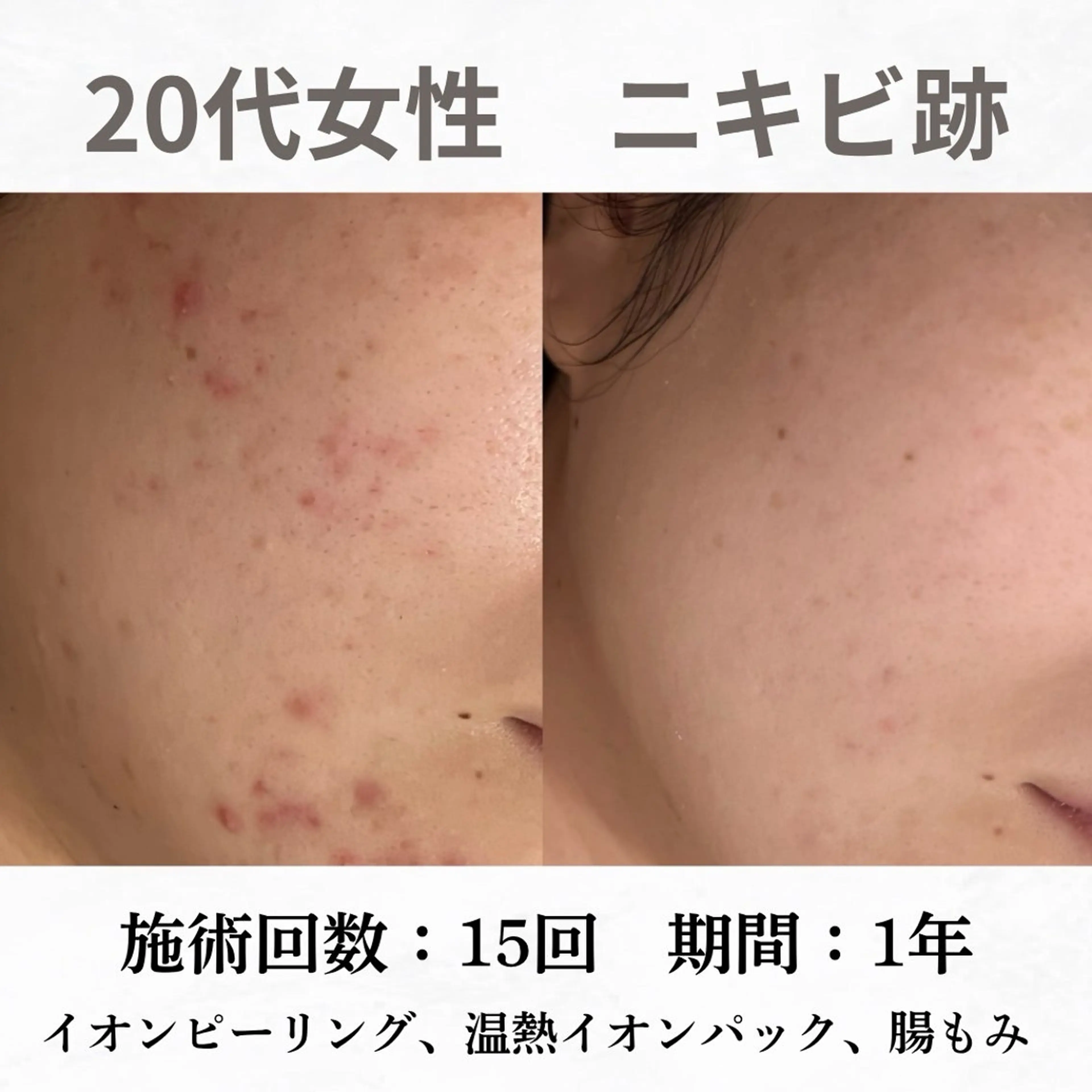 重度ニキビ専門🌷 ダウンタイムなしのエステ・リラクイメージ