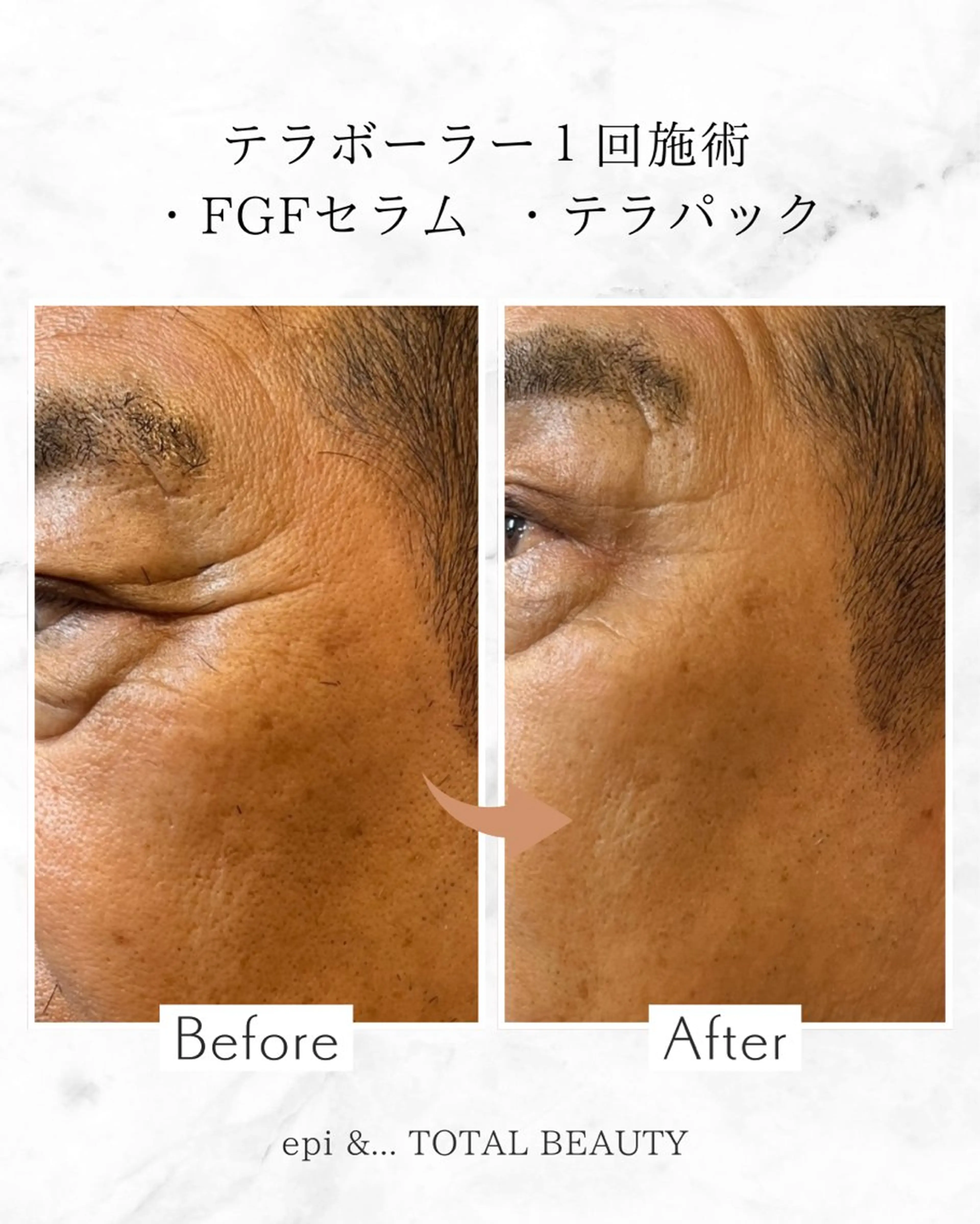 テラボーラー初回限定料金【￥8000】の写真