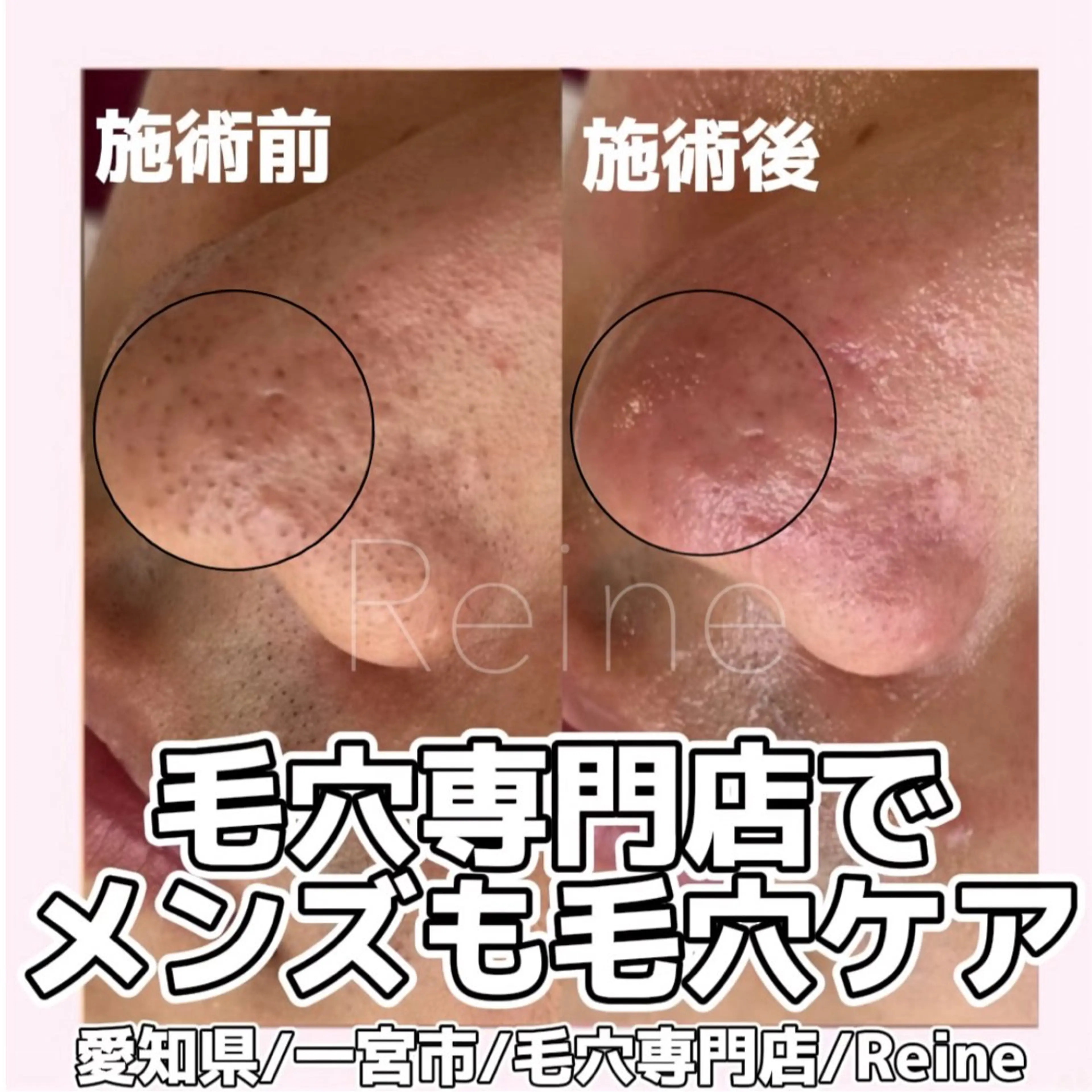 エステ Reine BeautySalon所属・毛穴/シミ肝斑/脱毛 横山梨里のエステ・リラクイメージ