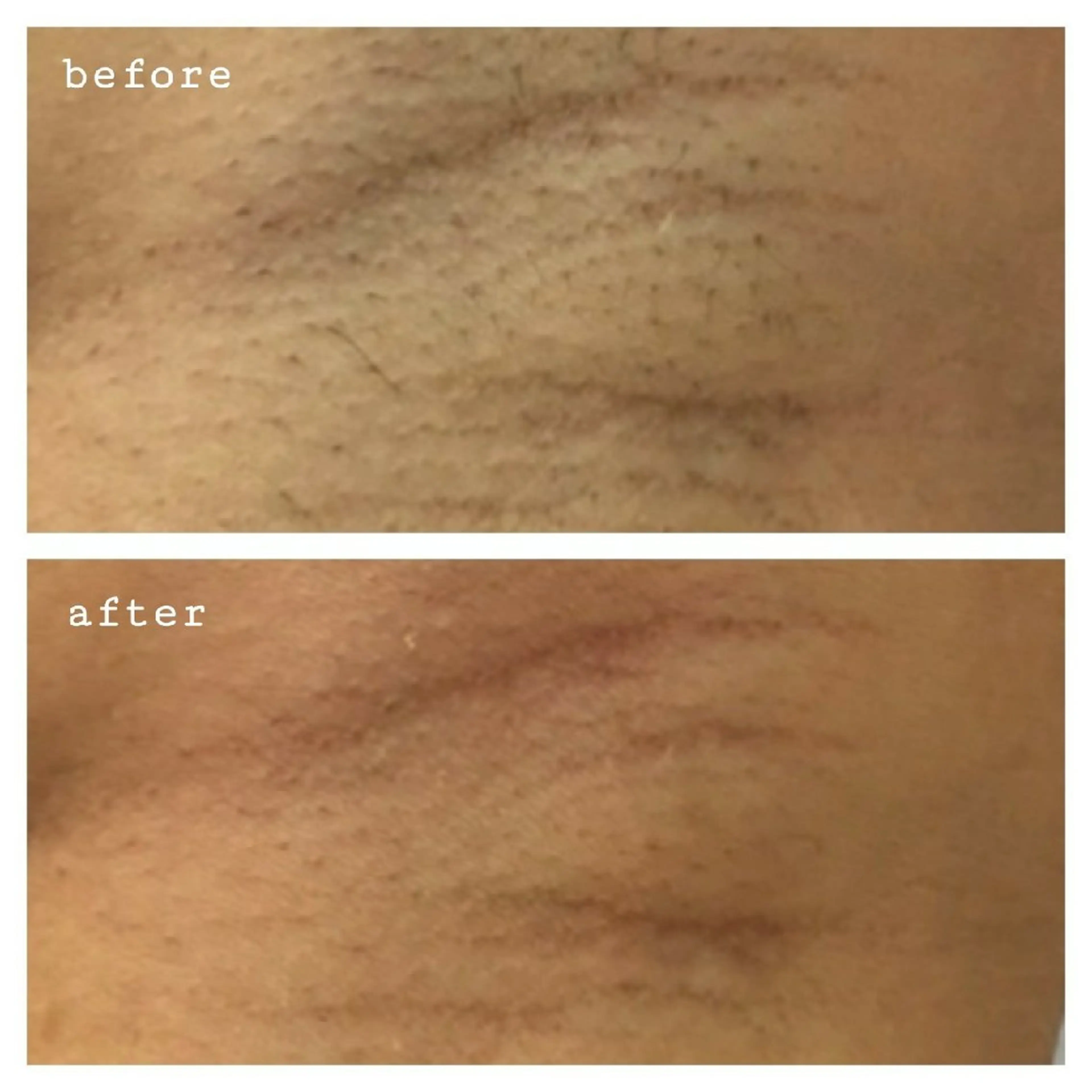 ご新規限定価格✨レディース脱毛❇️ワキ シェービング付きの写真