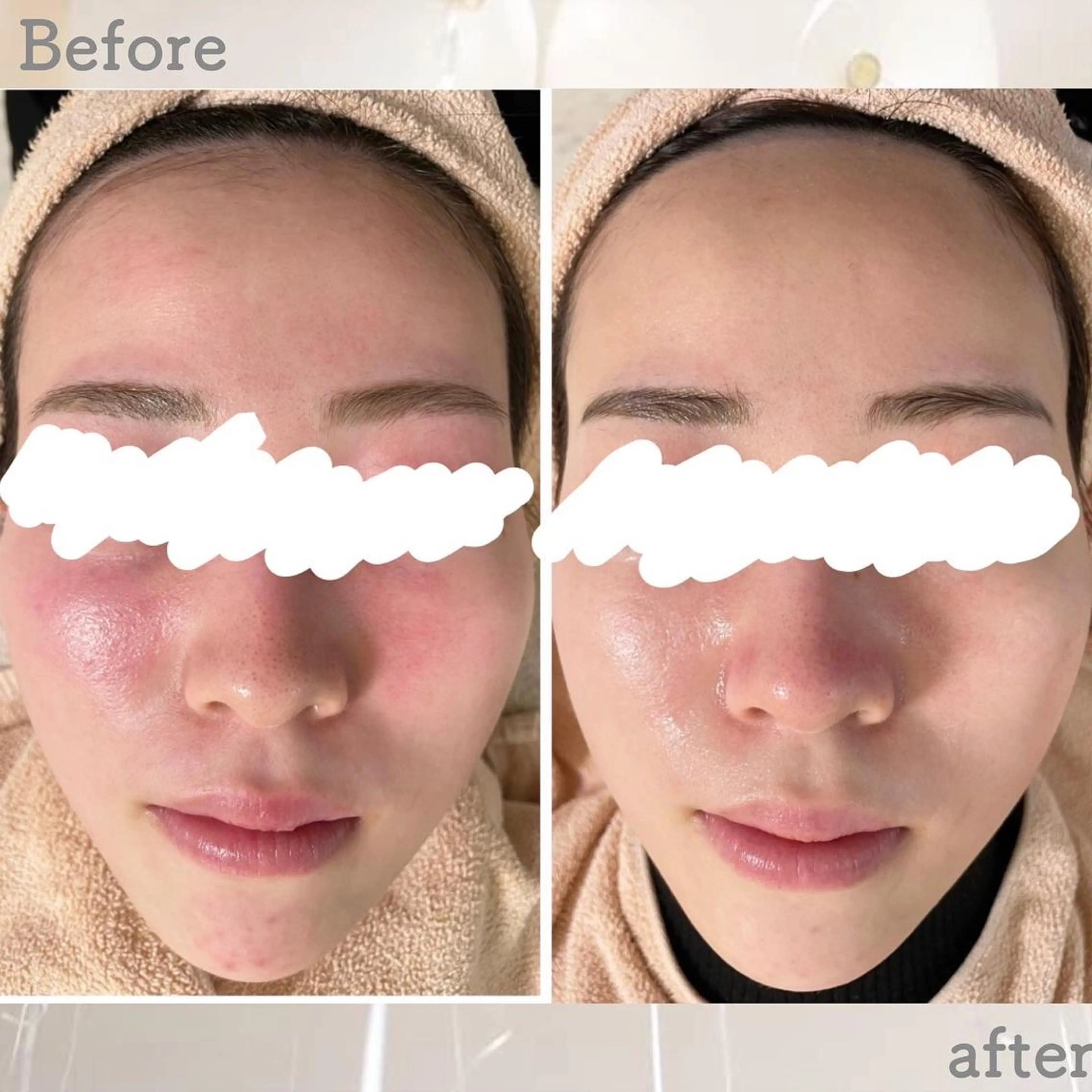 エステ ニキビ&跡改善サロン オーナー光木のエステ・リラクイメージ