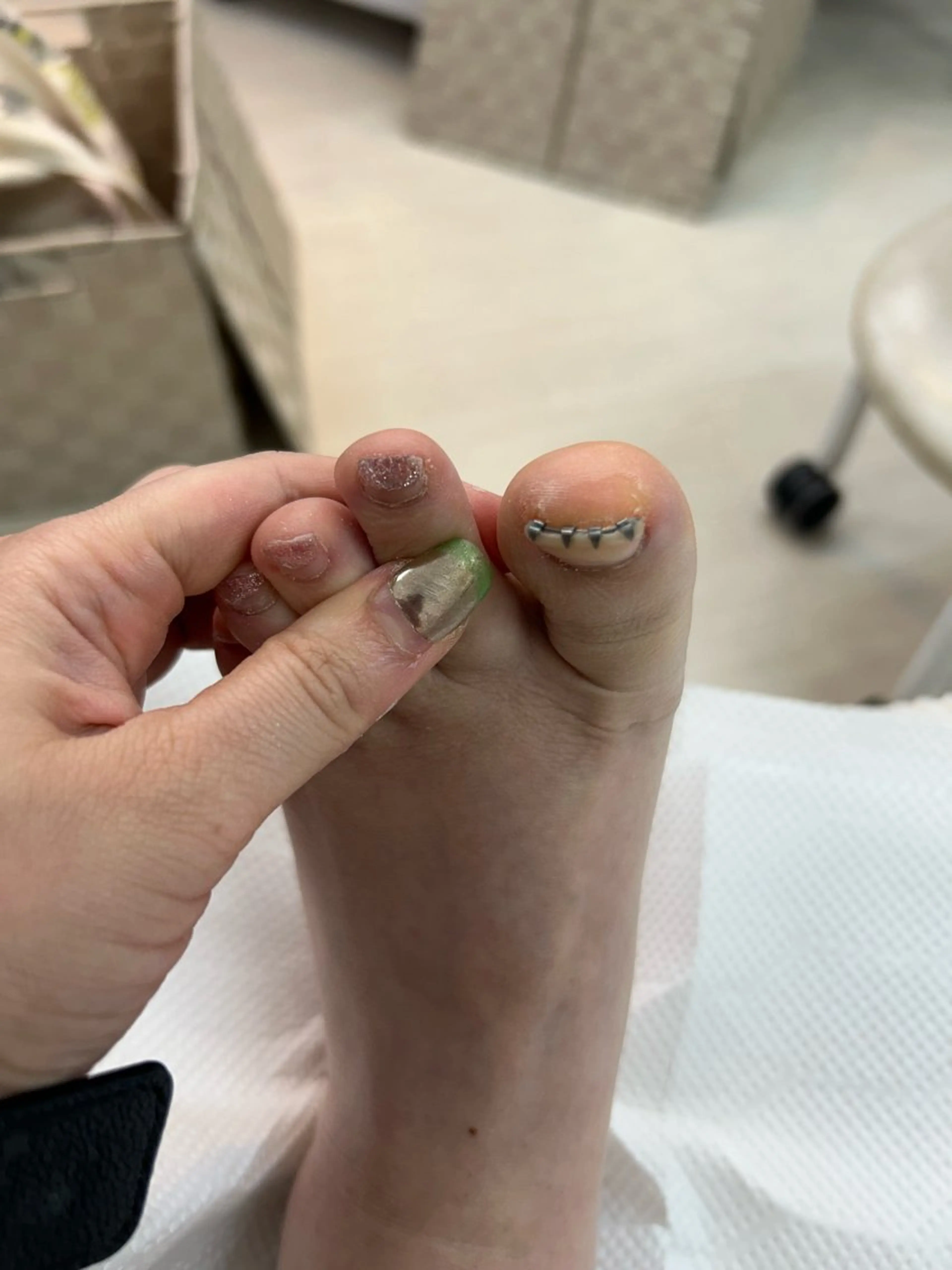 巻き爪矯正２本セットプラスフットワンカラーの写真