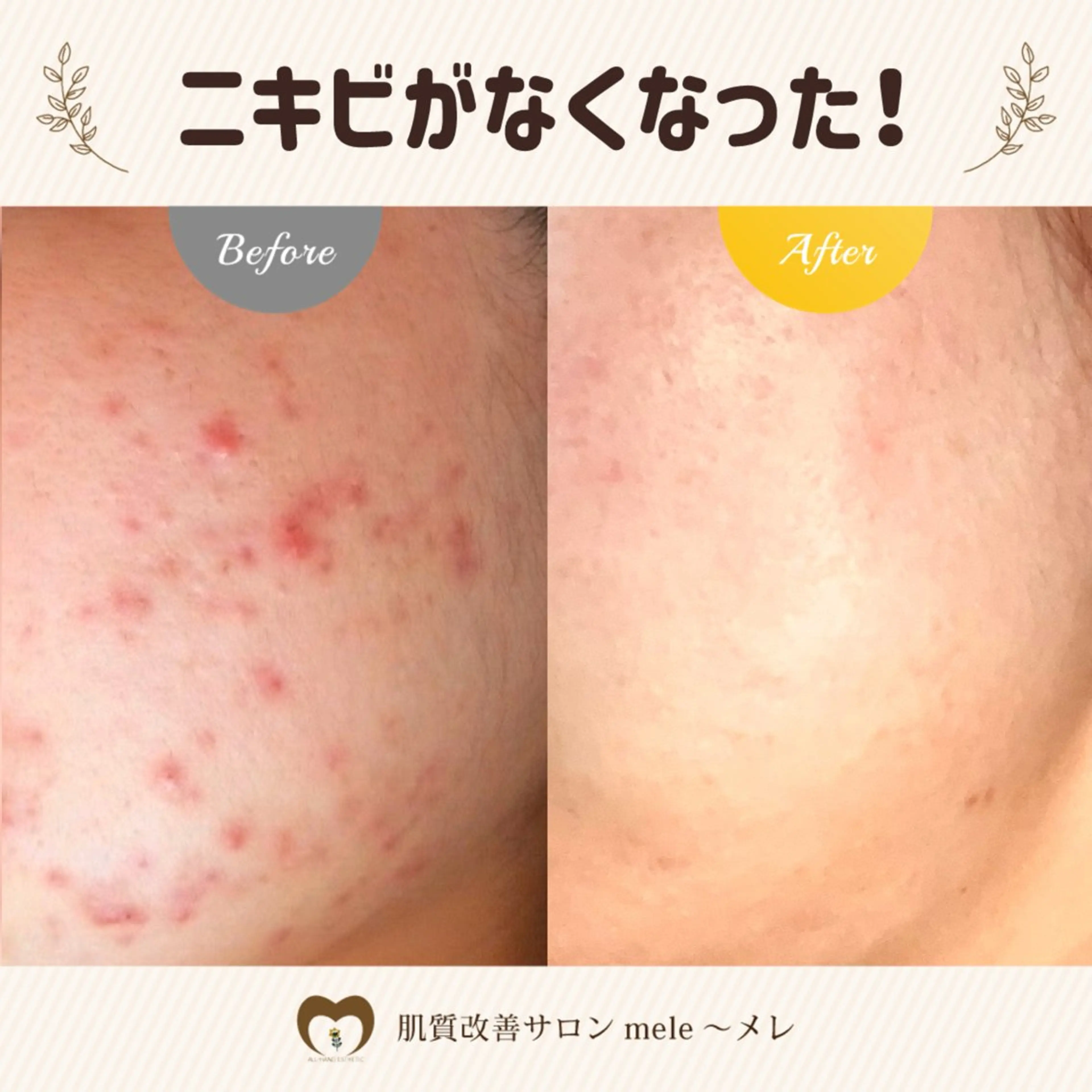 ニキビケア/毛穴/ 赤み/自信の肌✨森園のエステ・リラクイメージ