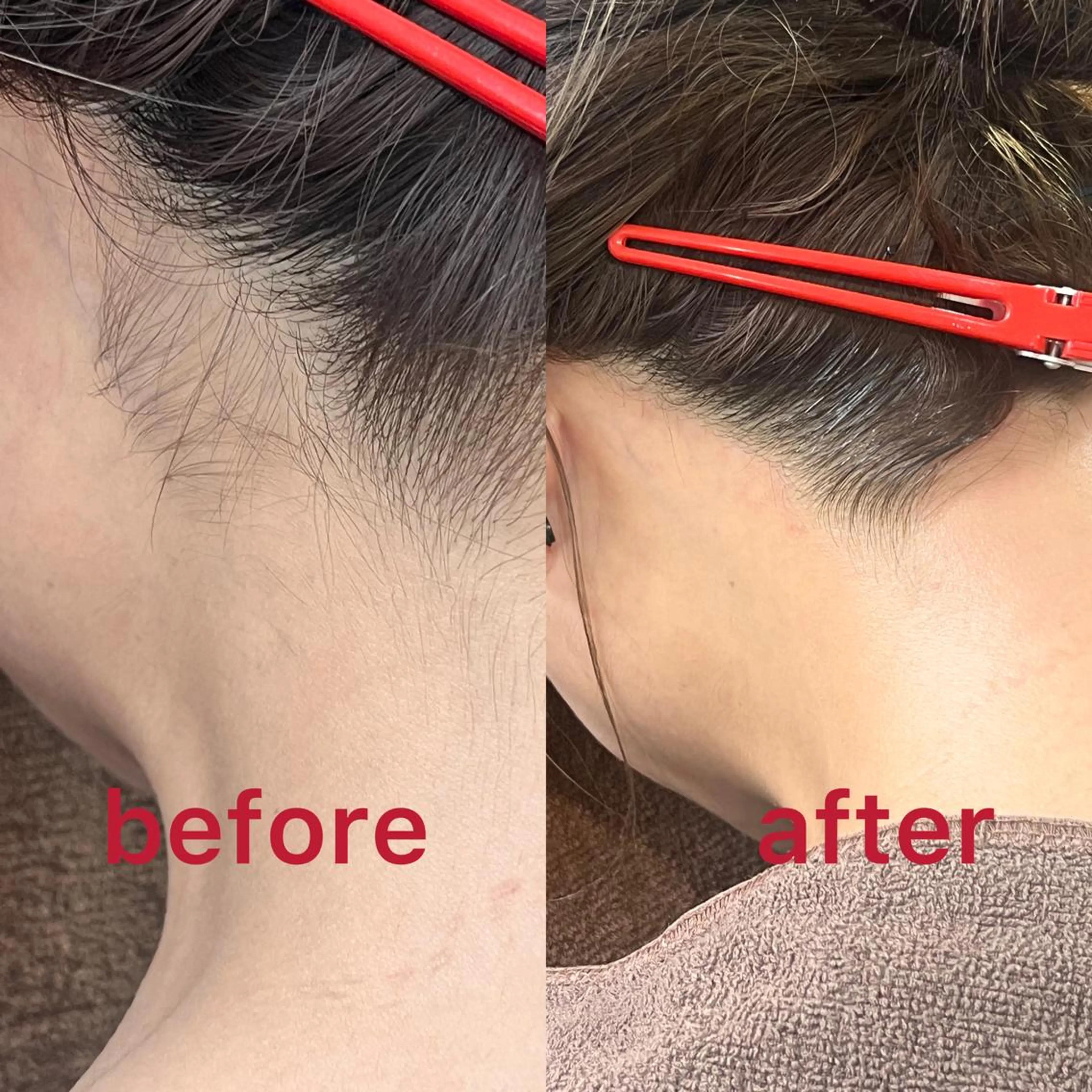 ミニモ限定【うなじツルスベワックス脱毛&最新THR光脱毛】メンズOK！の写真