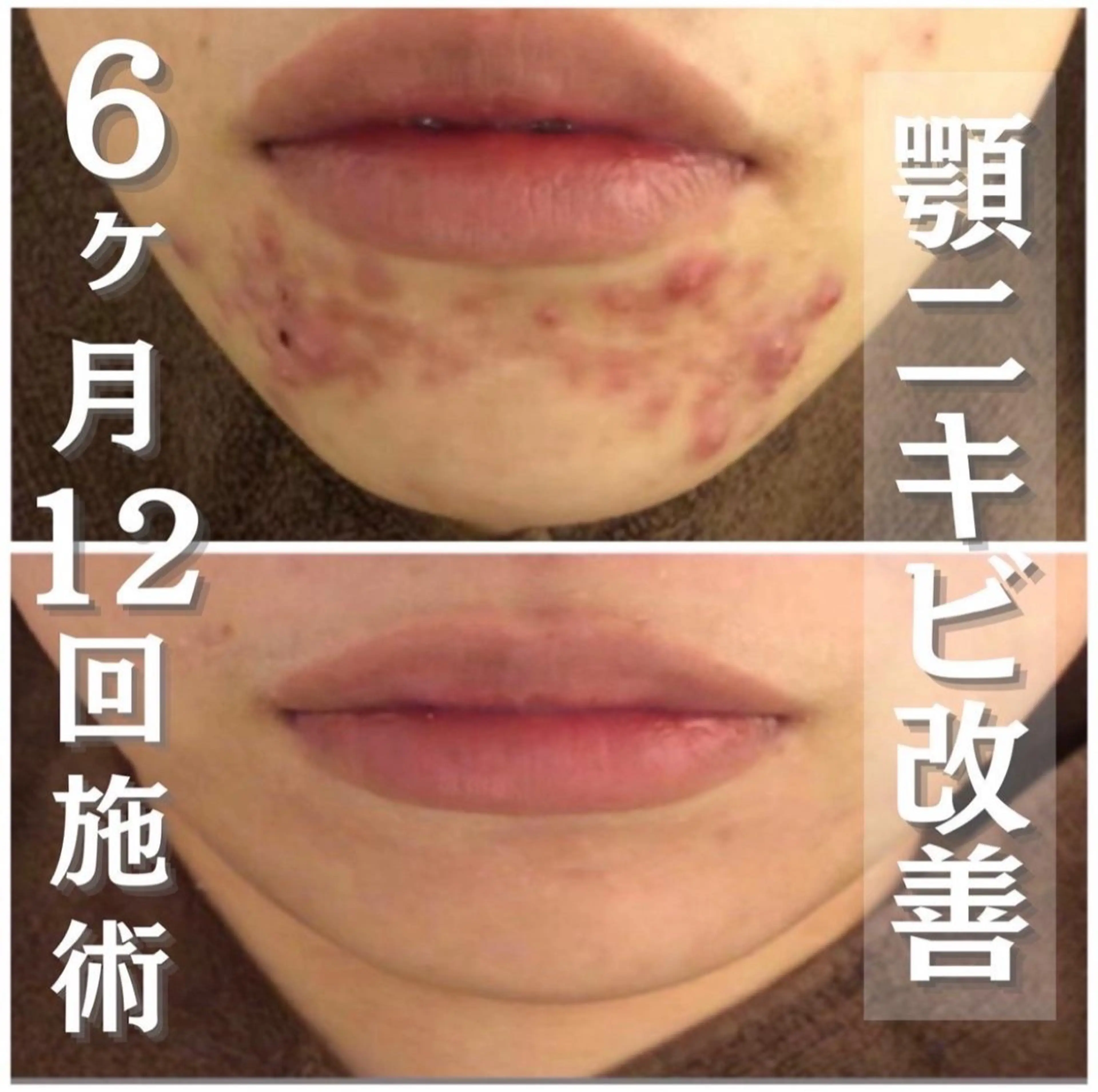 【じっくり効果を見たい方へ🍀】イオンピーリング＋温熱イオンパック2回分🧸⭐️の写真