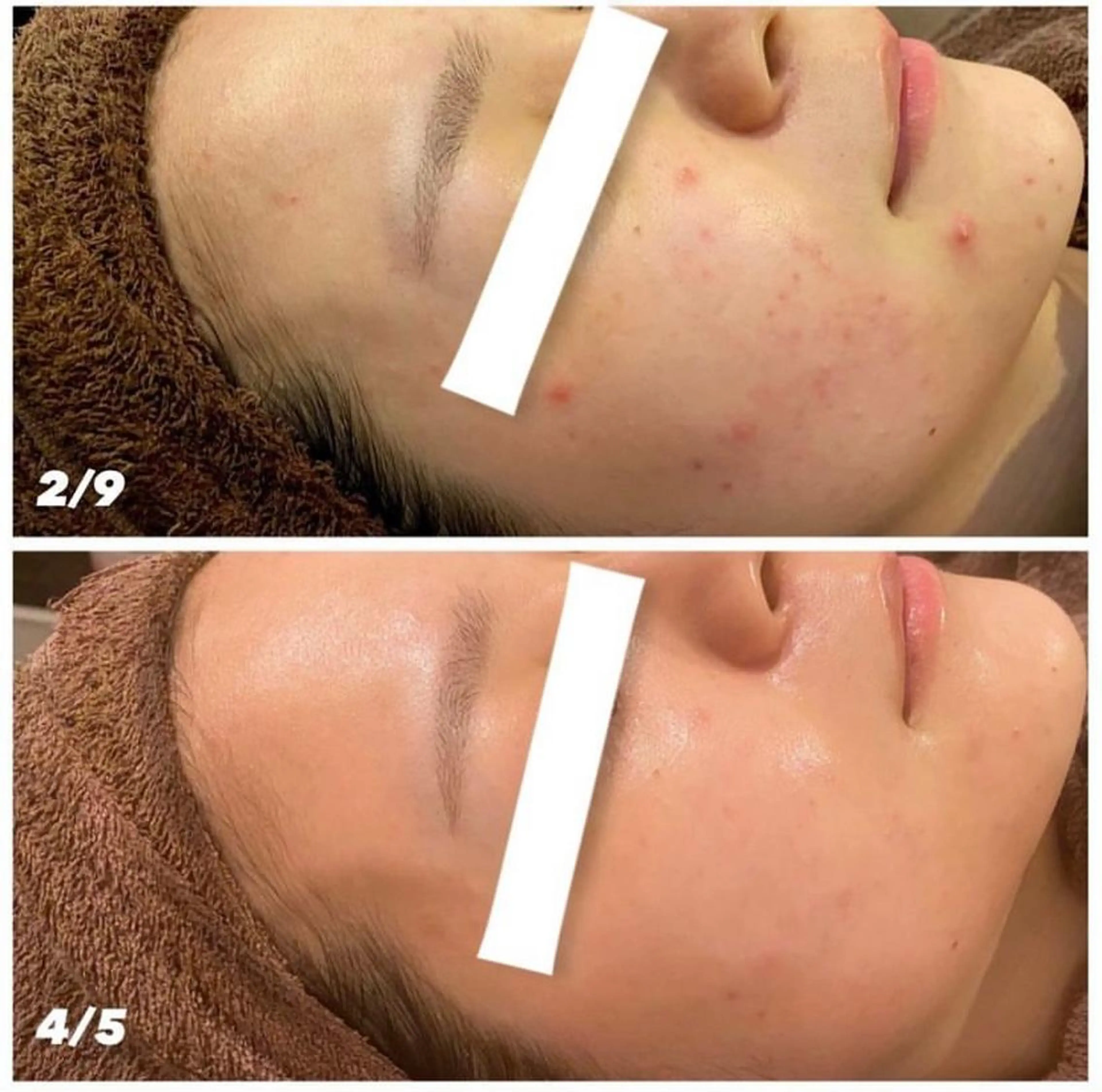 肌質改善ハーブピー リング🌿RINAのエステ・リラクイメージ