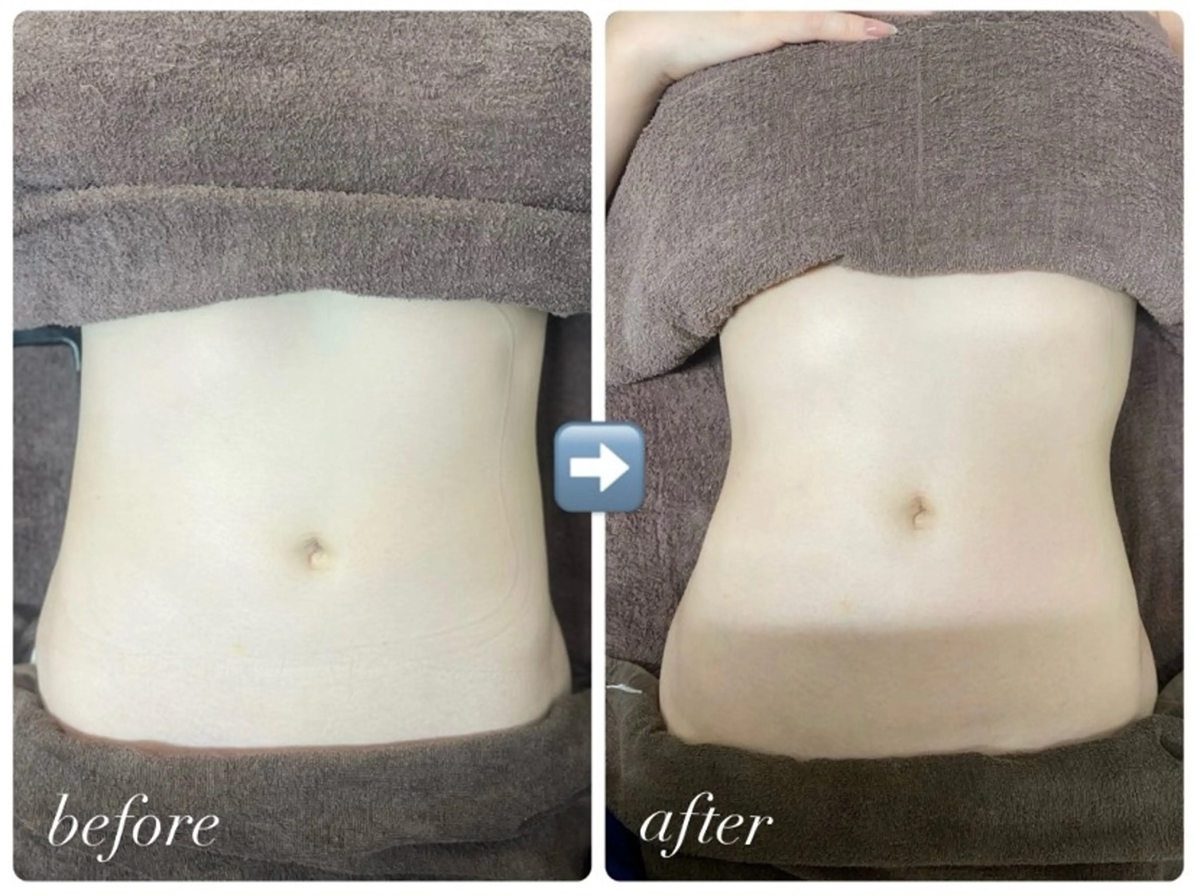 🇰🇷カーボキシー炭酸ガスパック施術60分🫧Lパーツ（お腹、背中、お尻）の写真