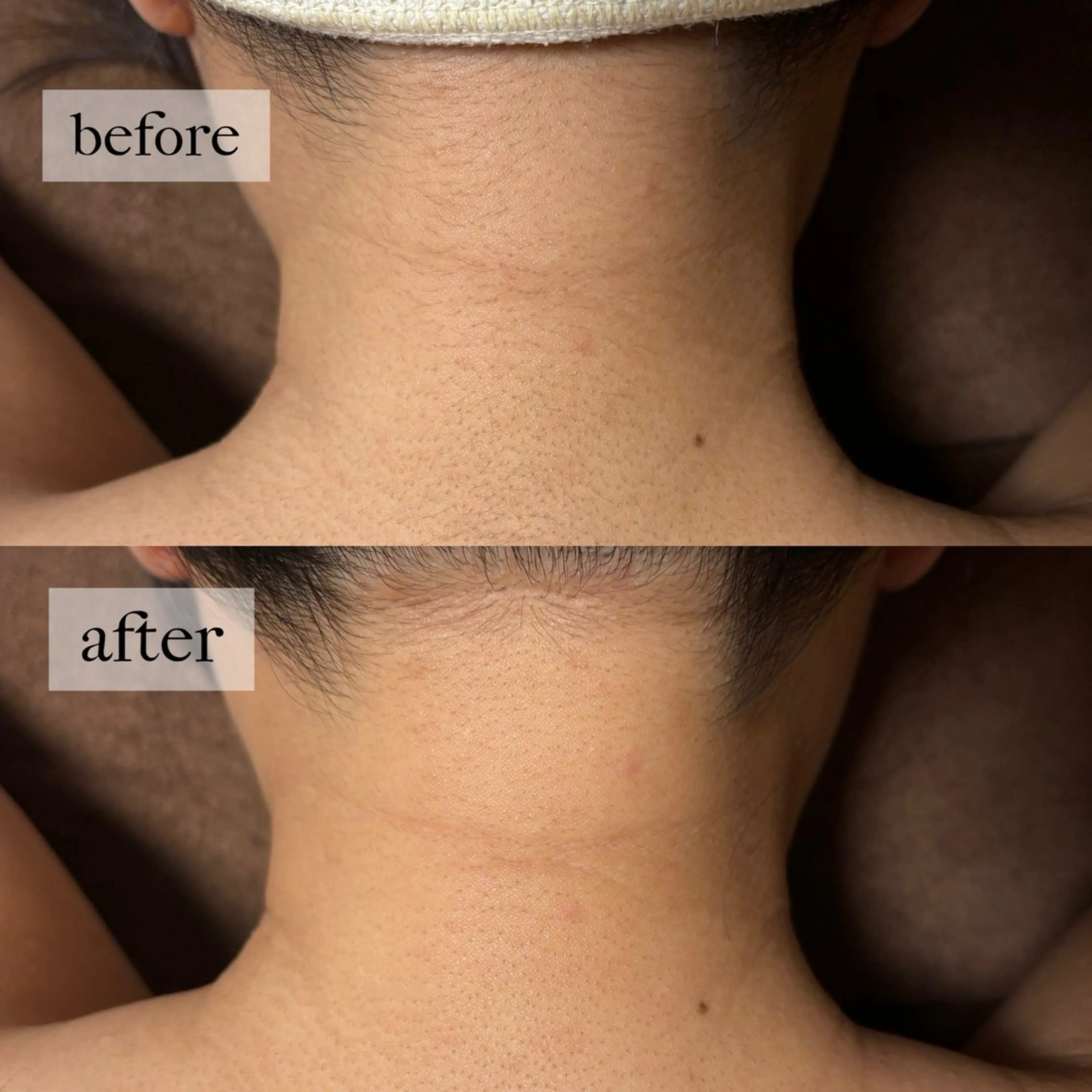 HINANO矢場町店【ヒナノ】所属・脱毛/肌改善🌿 HINANO 村田のエステ・リラクイメージ