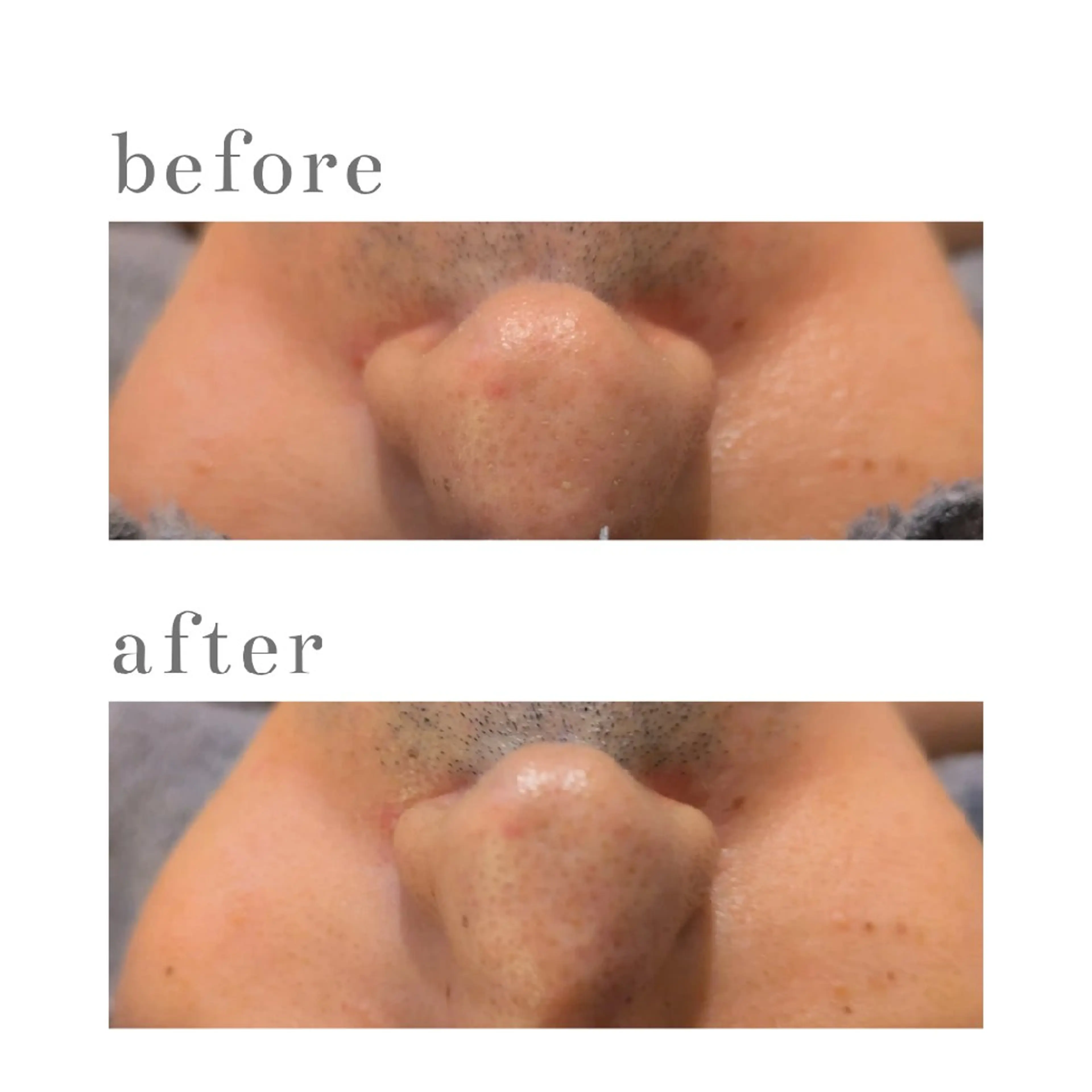 【お試し！本気の肌改善】✨️ハーブピーリング（クリスタルパック）60分＊の写真