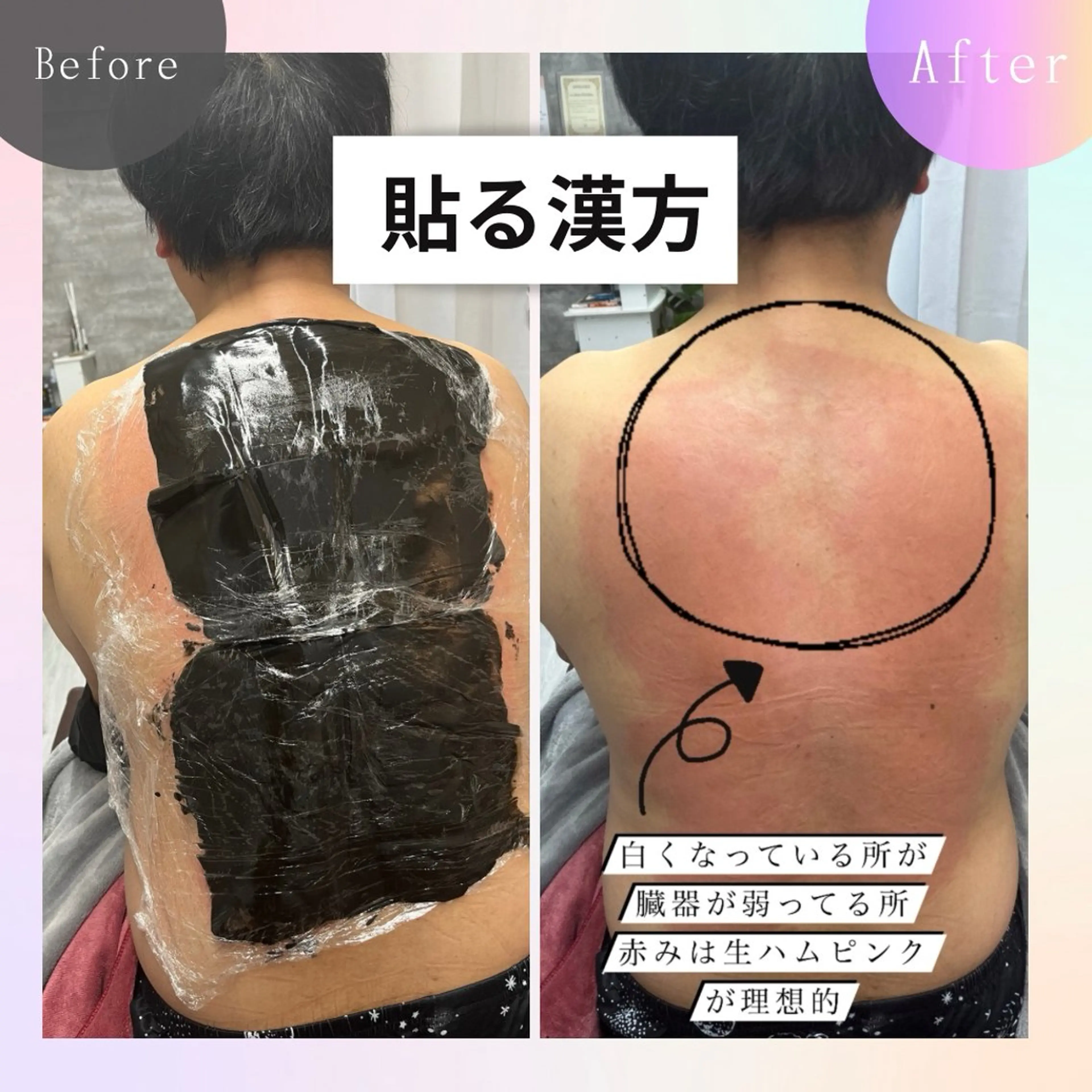 【※最低5回受けれる方※】よもぎ蒸しを超える！！“貼るタイプ”ハーブ温熱パック🌿(2部位)足裏マッサージ付き50分の写真