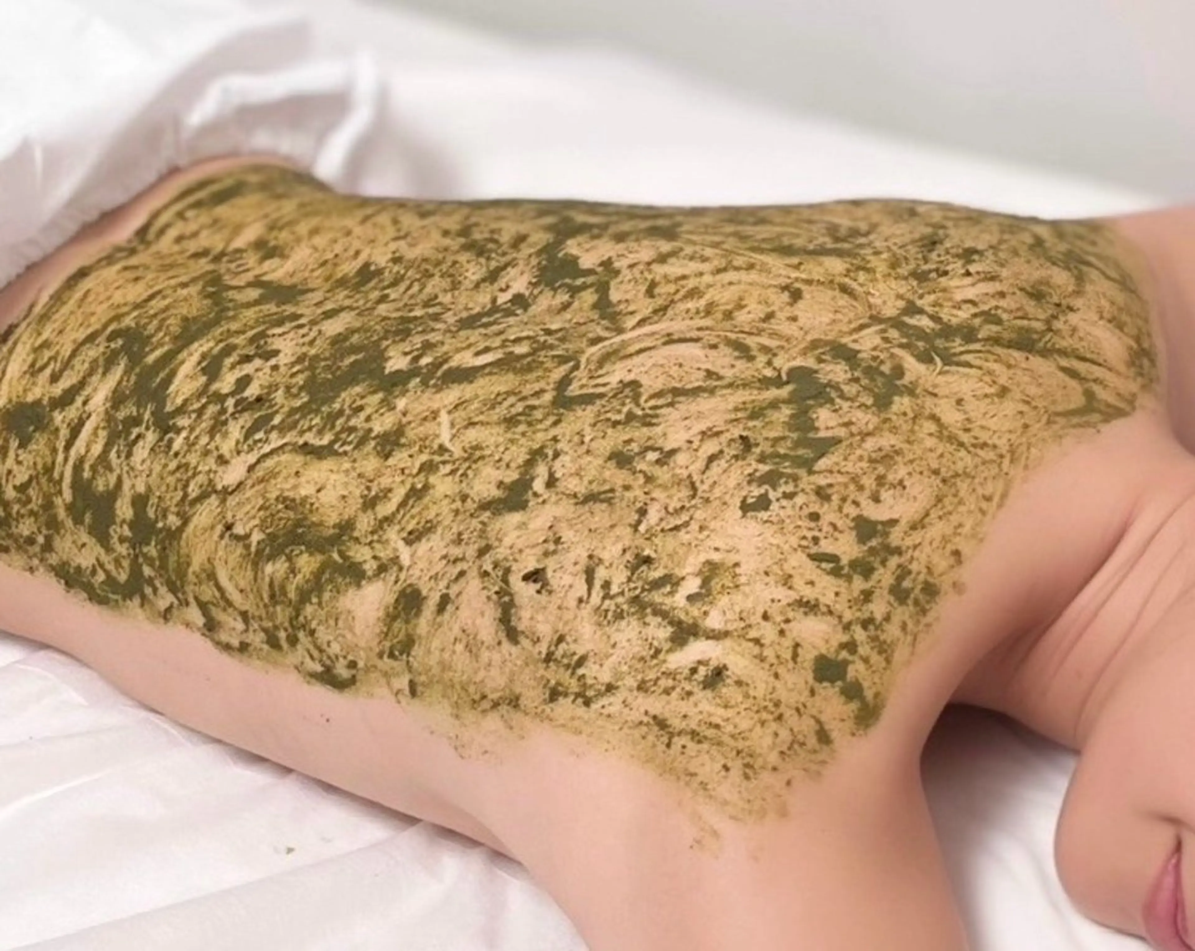 【ニキビ・肌荒れ跡・しみ】背中ハーブピーリング　初回3,000円OFFの写真