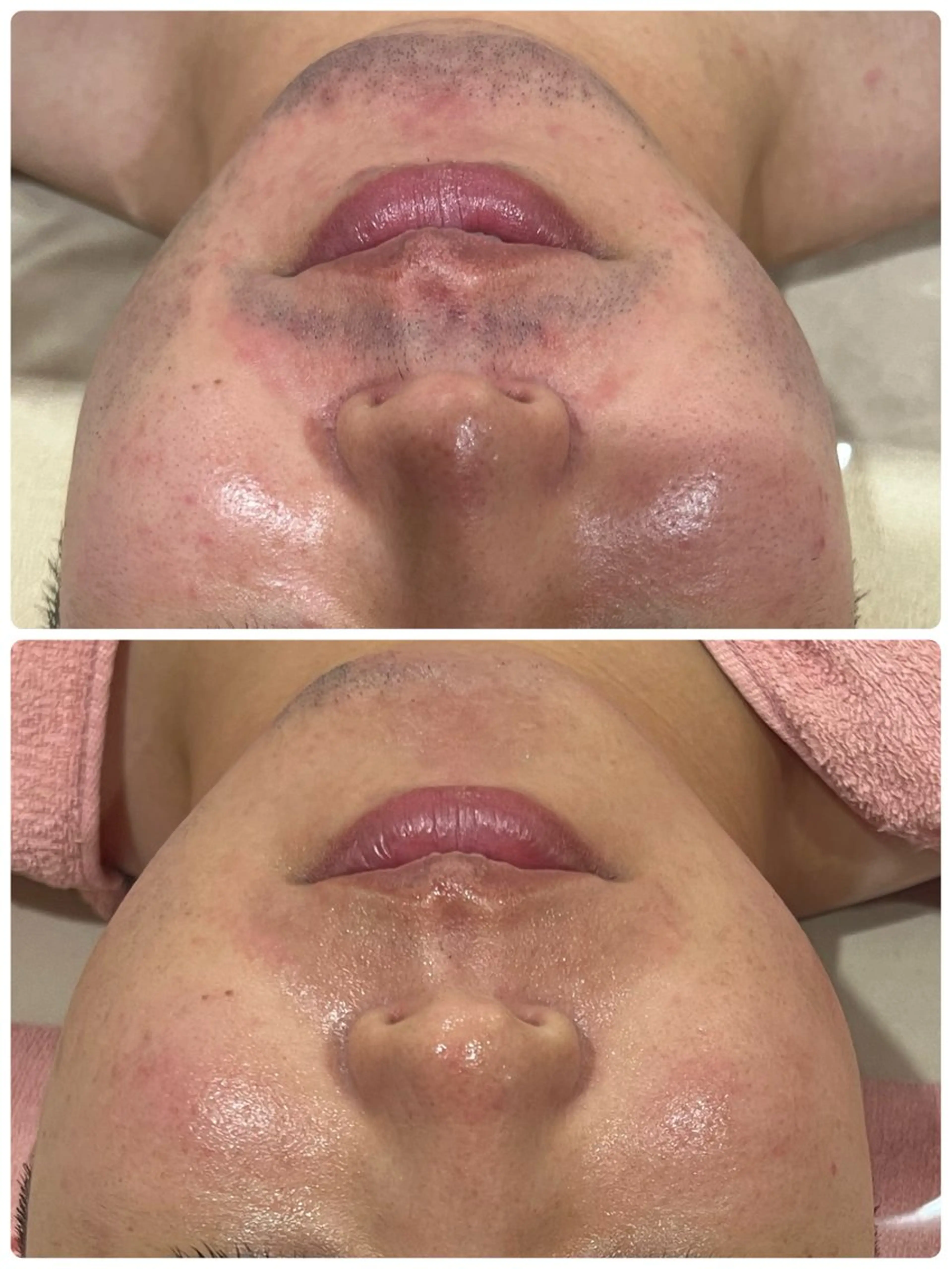 メンズ👱‍♂️💙大特価キャンペーン☆【頬～首までしっかりヒゲ脱毛】の写真