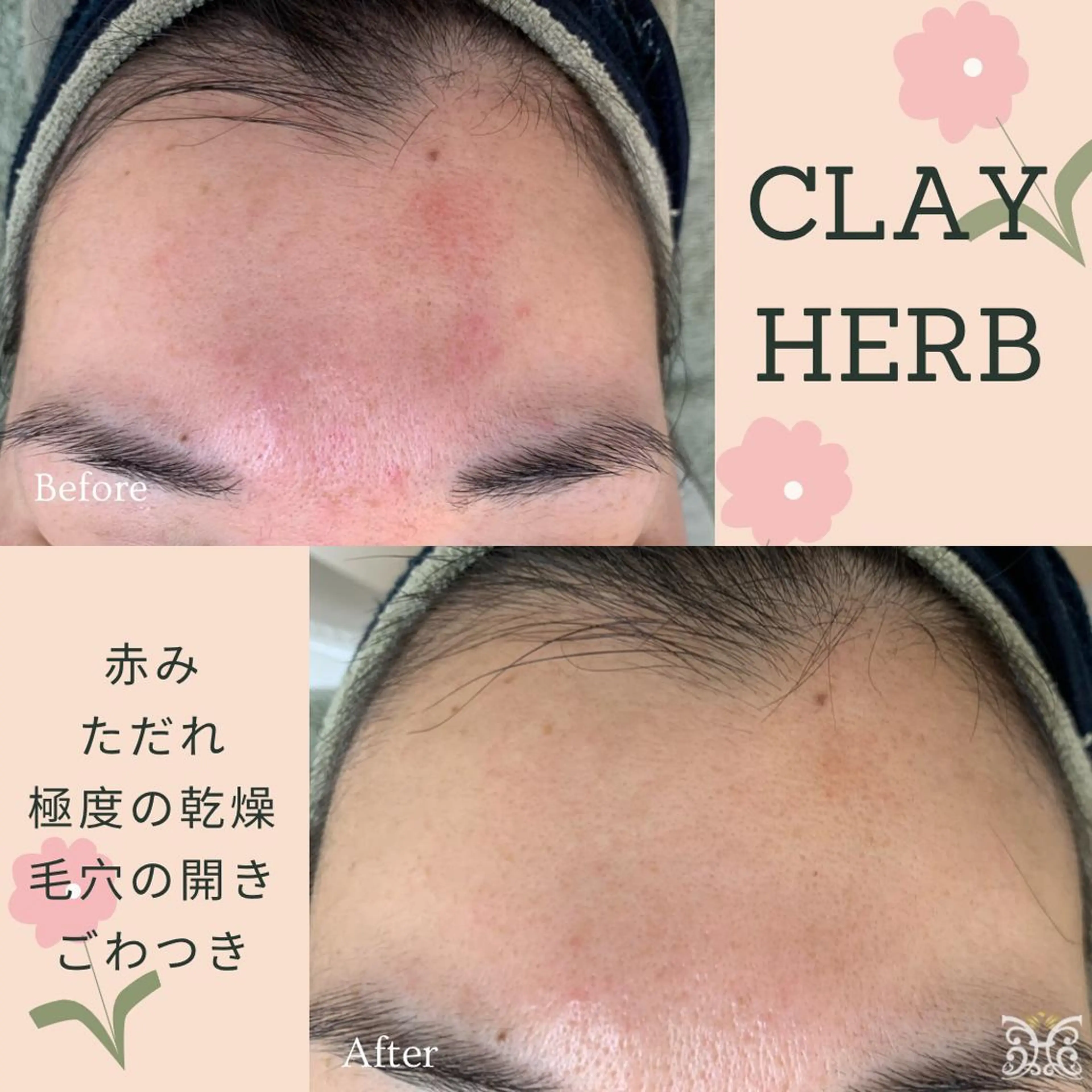 エステ リラク 【剥離ありハーブピーリング専門エステ】cerisier BEAUTÉ 原宿所属・cerisier BEAUTÉのエステ・リラクイメージ