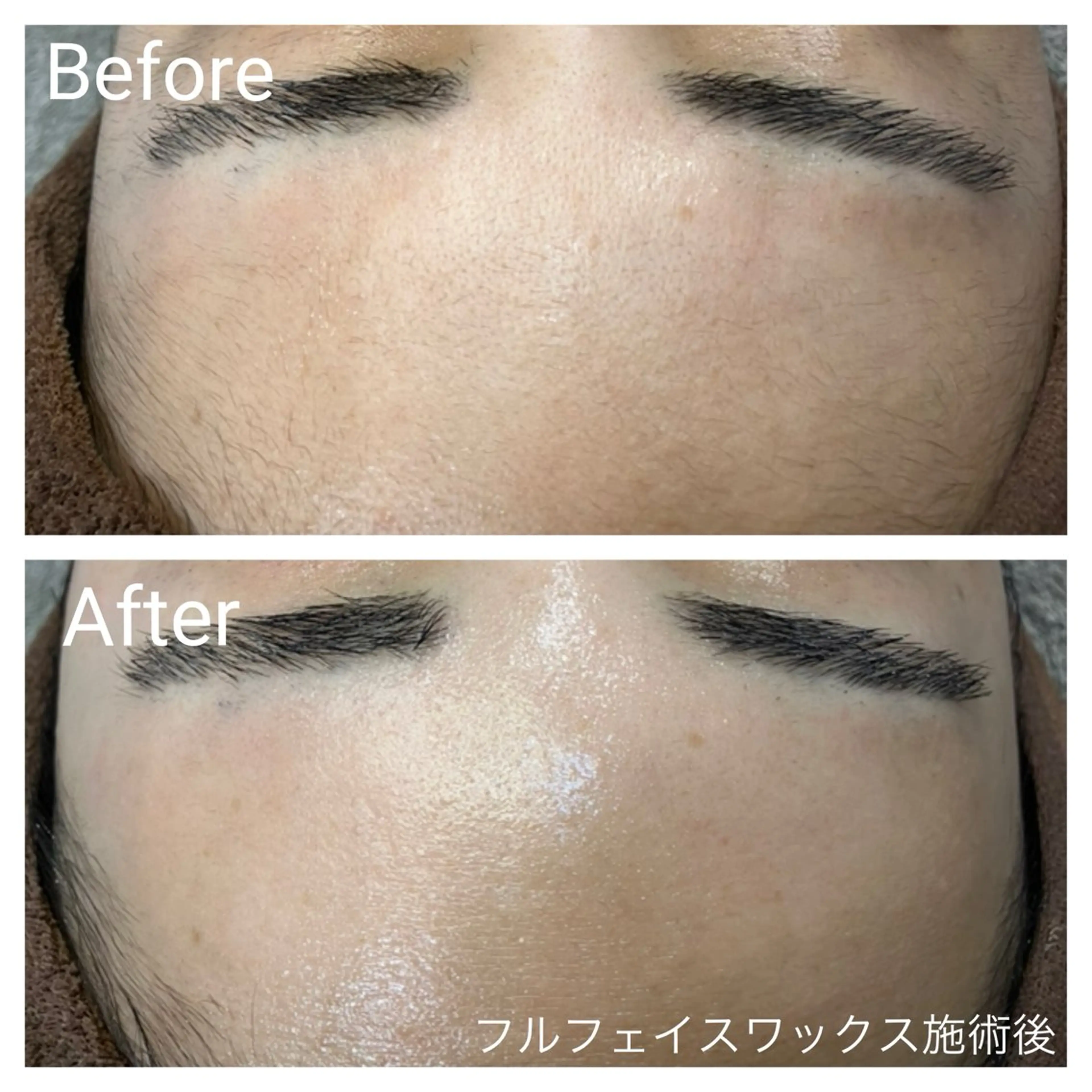 【ざらつき・艶肌・産毛に⭐️】艶肌フェイスワックス(全顔)80分の写真