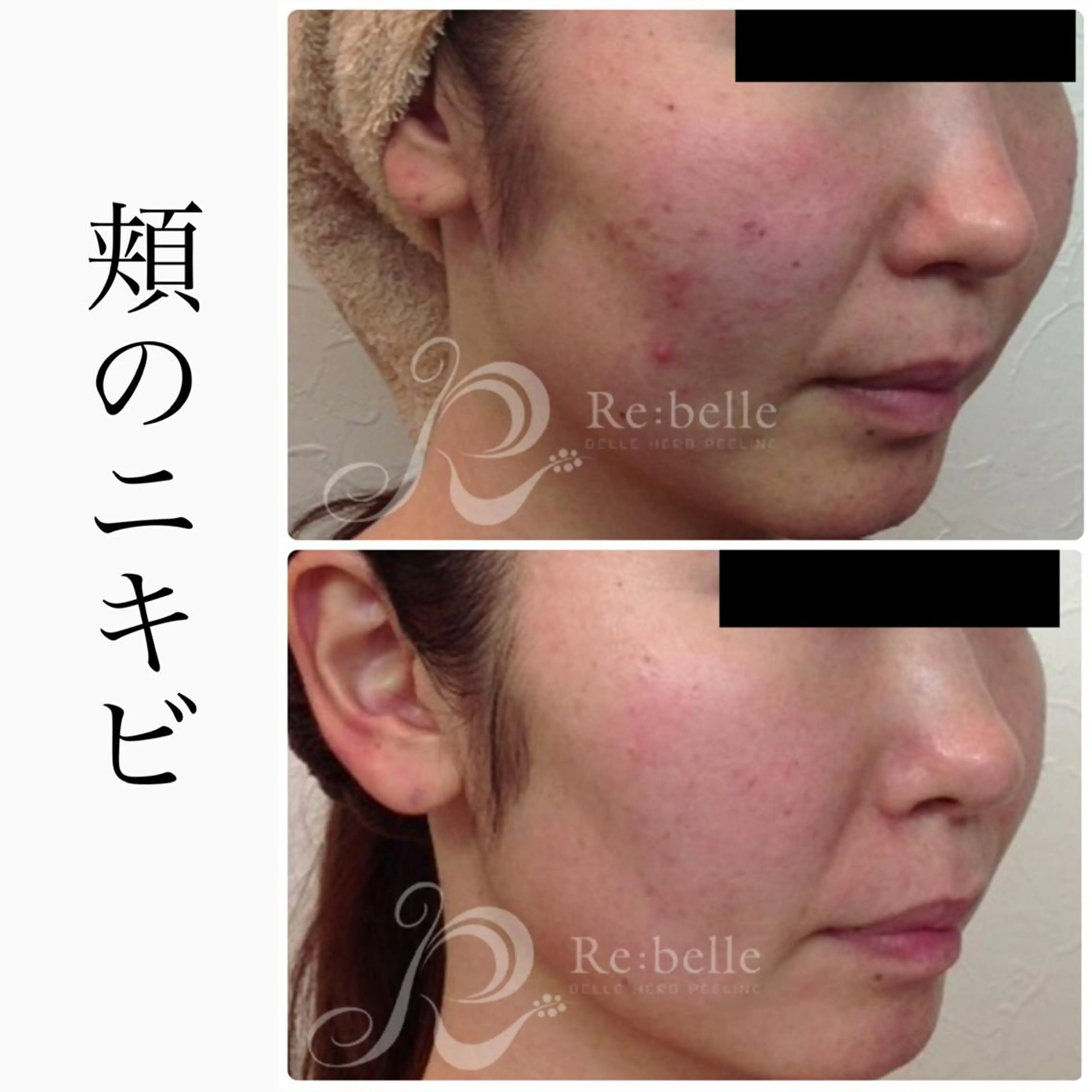 エステ BeSkin藤沢店所属・ニキビ/肌質改善 BeSkin 藤沢店のエステ・リラクイメージ