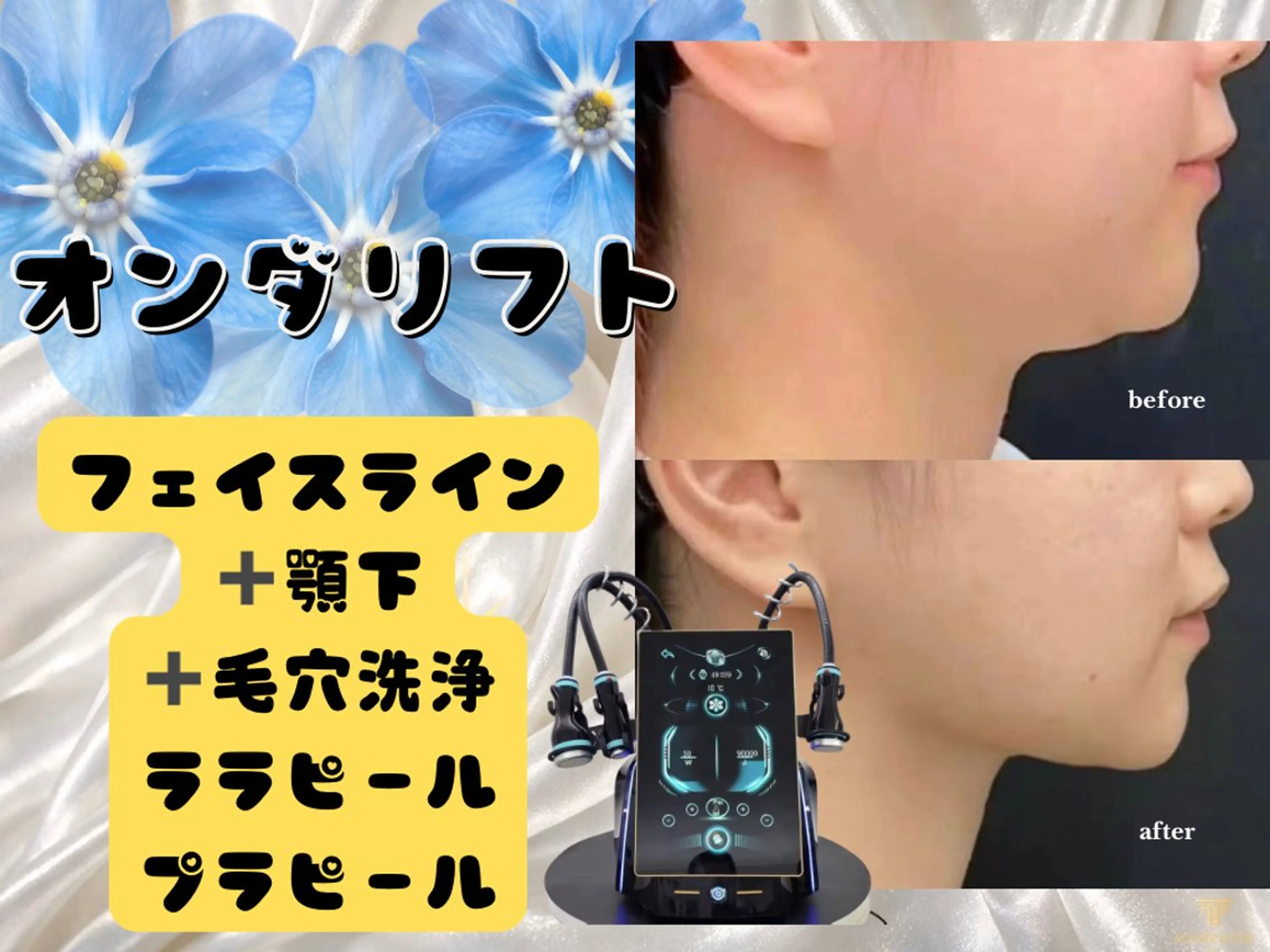 オンダリフト25分｜フェイスライン顎下80kj~140kj＋鼻の毛穴洗浄＋ララピールorプラピールの写真