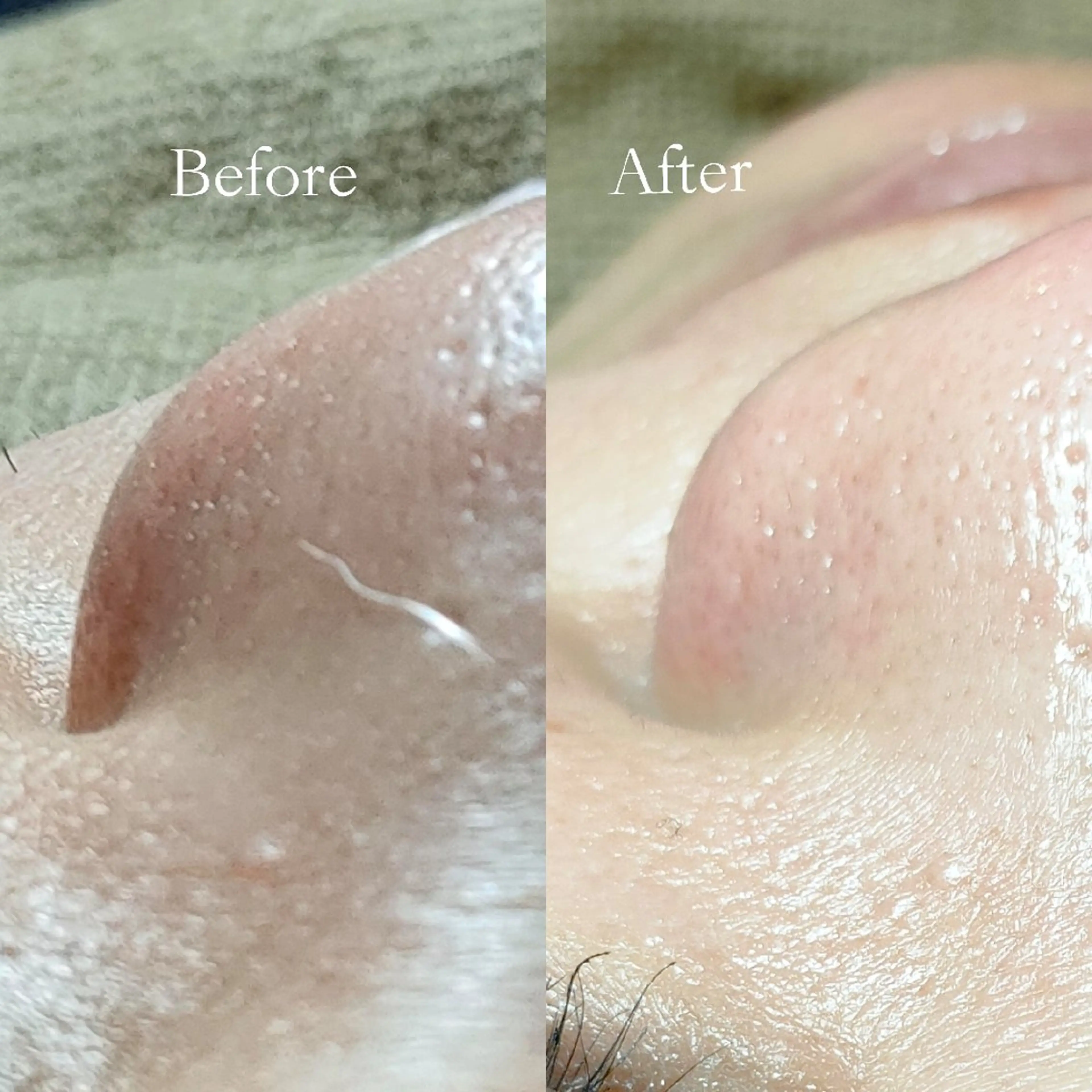 🌸フェイスワックス(特別潤いパック仕上げ)+美肌光脱毛=ダブル脱毛の写真