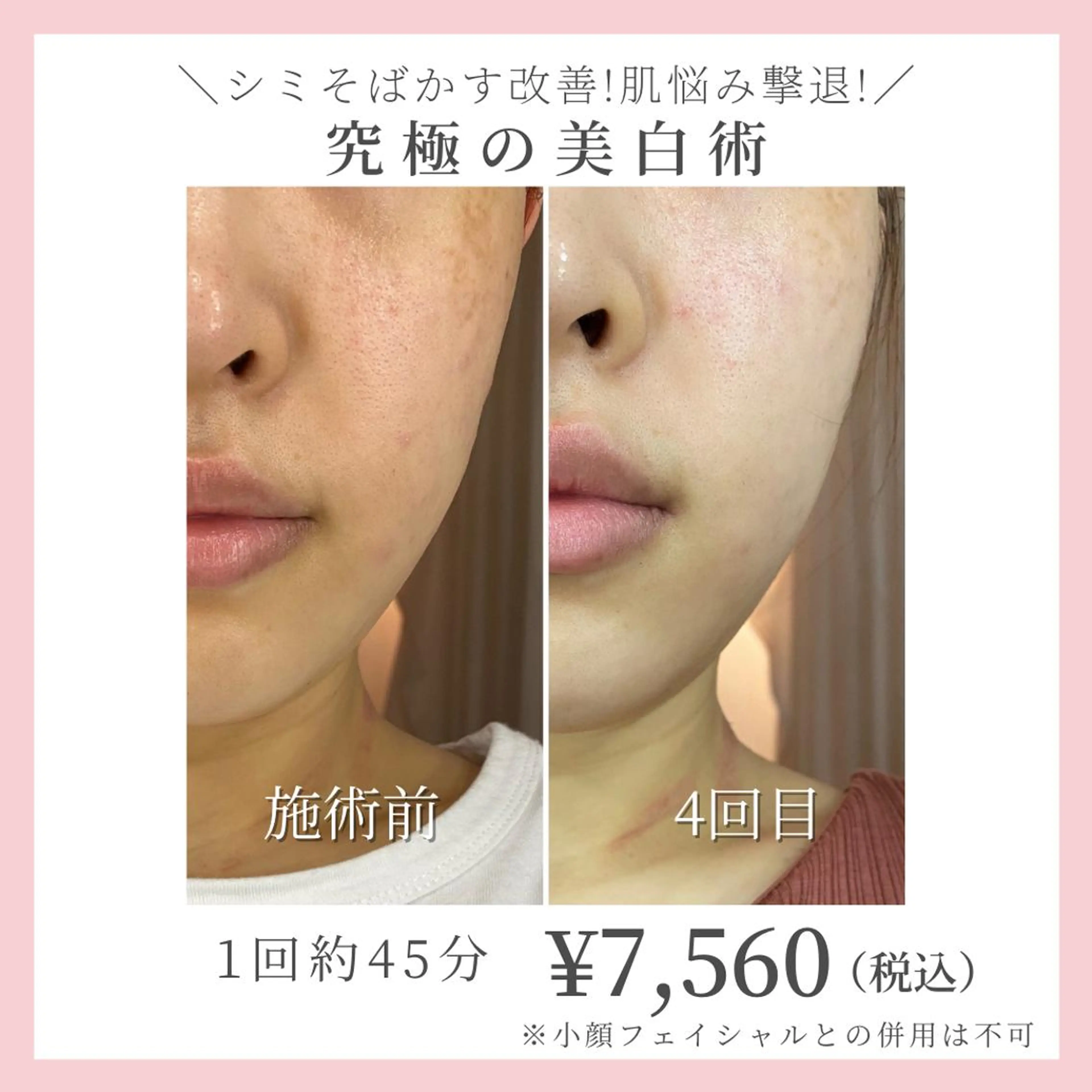 【シミ・そばかす・かんぱん改善！肌悩み撃退！！】究極の美白術☆1回約45分の写真