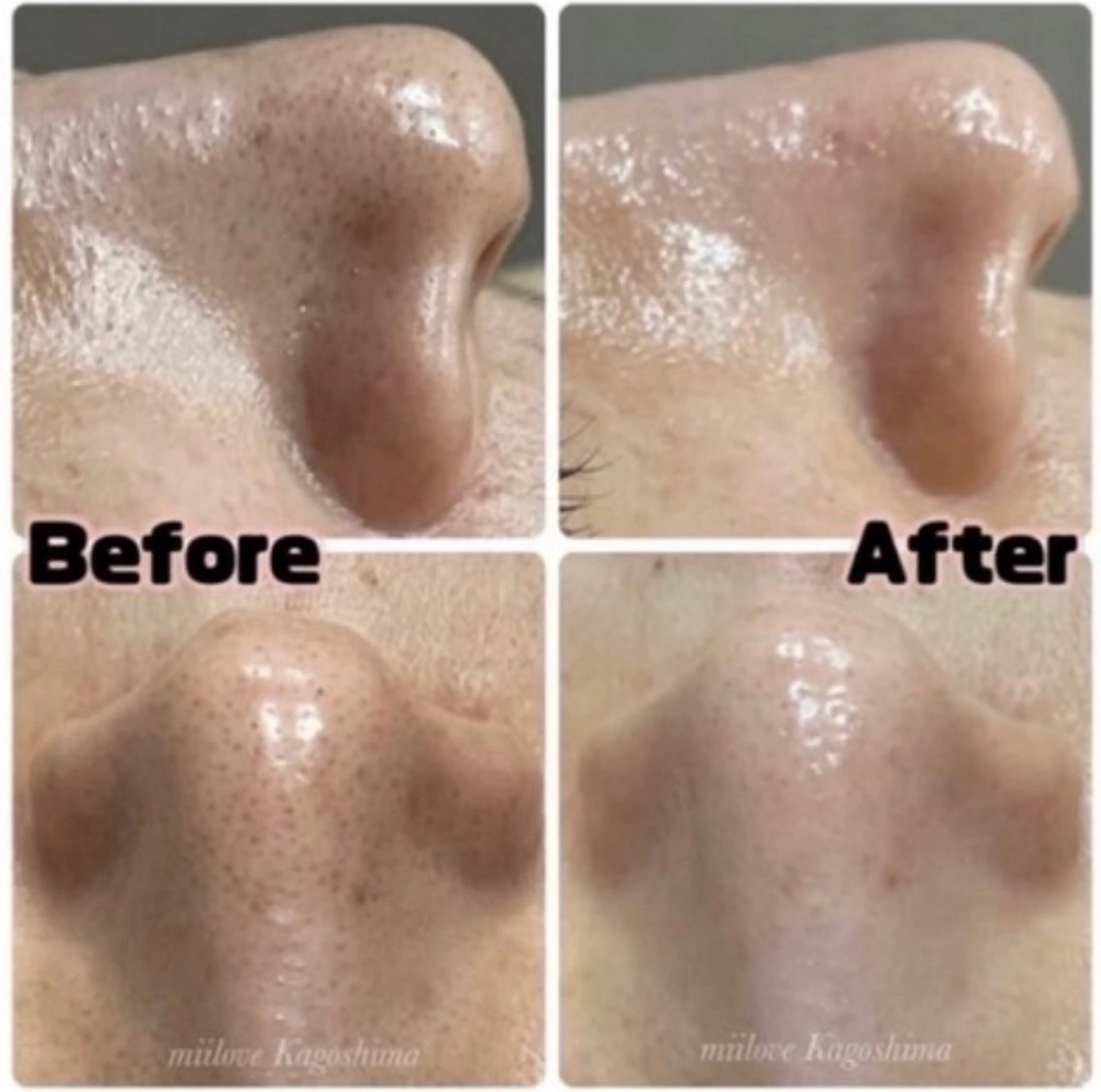 毛穴専科★ザラつき黒ずみもツルツル毛穴毛穴引締めパック&ヘッド付60分の写真