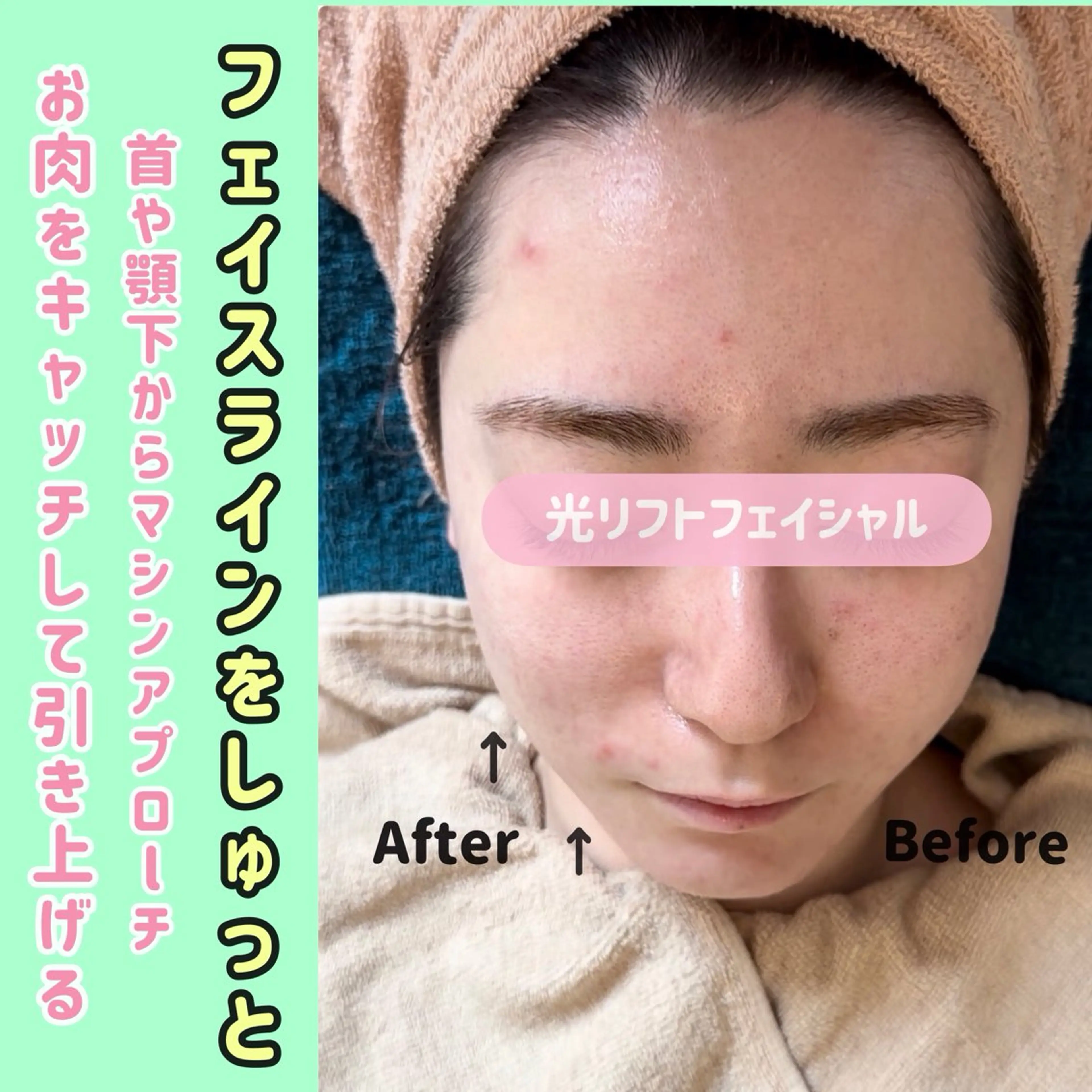 全顔フォトリフト💆♀️垂れ下がった、げっそりした頬を引き上げる✨の写真