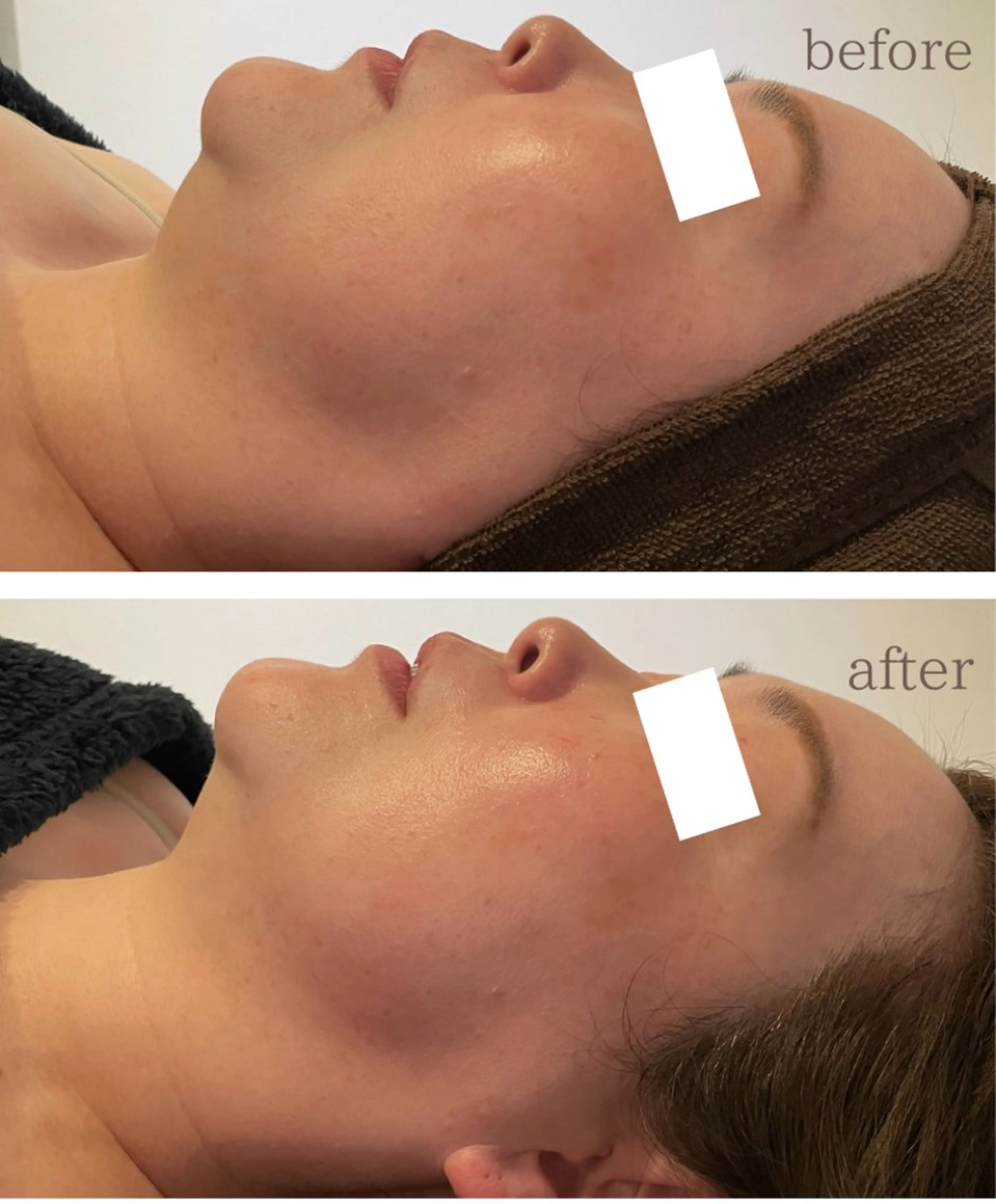 エステ Chalon所属・REVI取扱・肌悩み 毛穴Chalonのエステ・リラクイメージ